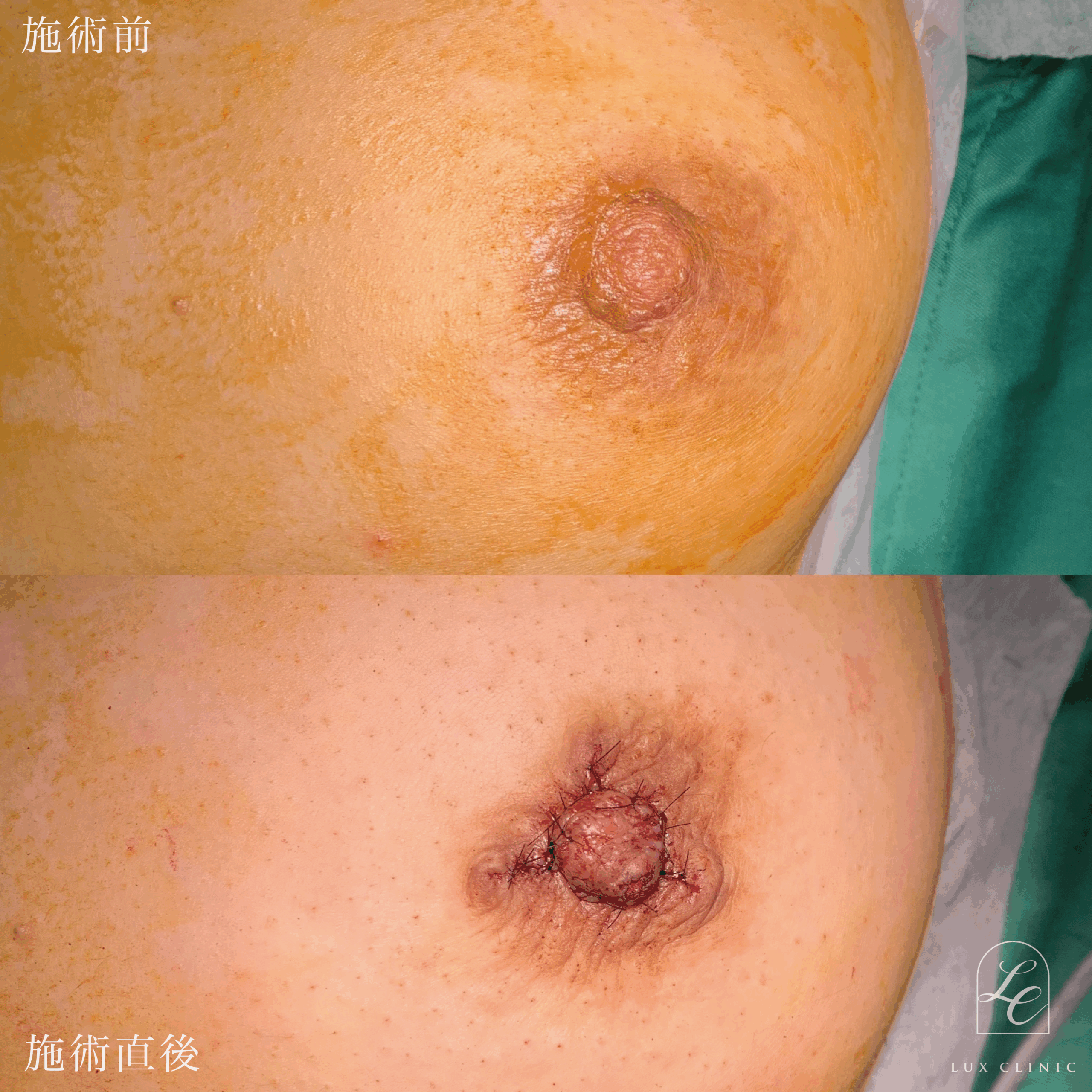 扁平乳頭　乳頭形成術