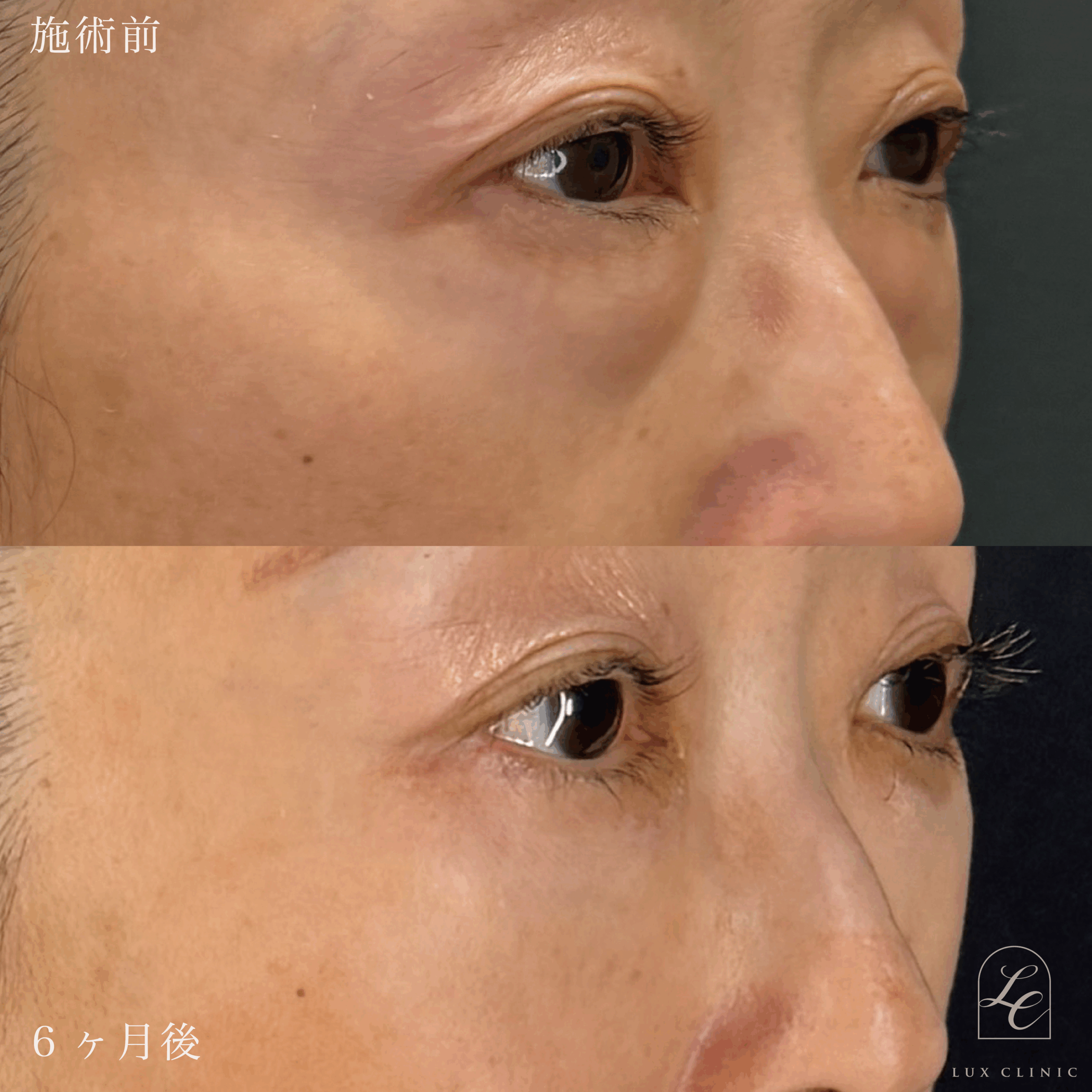 表ハムラ