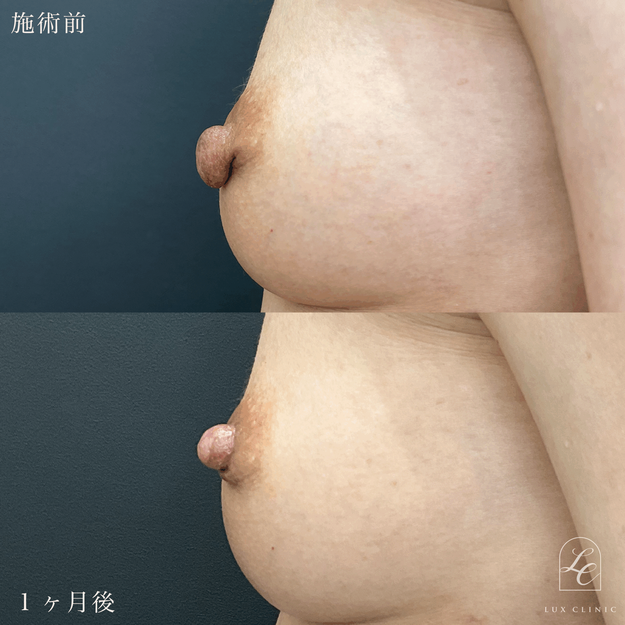 乳頭縮小術（乳管温存あり）