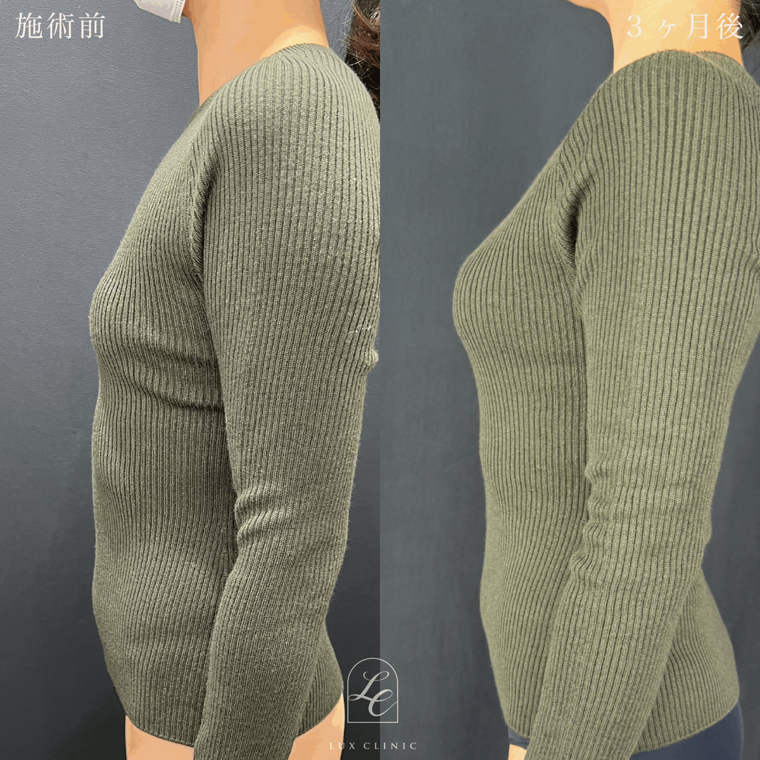 シリコンバッグ豊胸（乳腺下切開）motiva ergonomix2 210cc demi