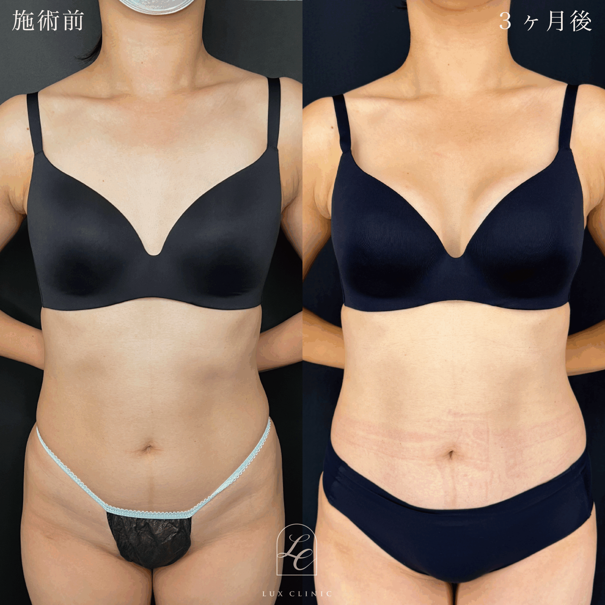 シリコンバッグ豊胸（乳腺下切開）motiva ergonomix2 210cc demi