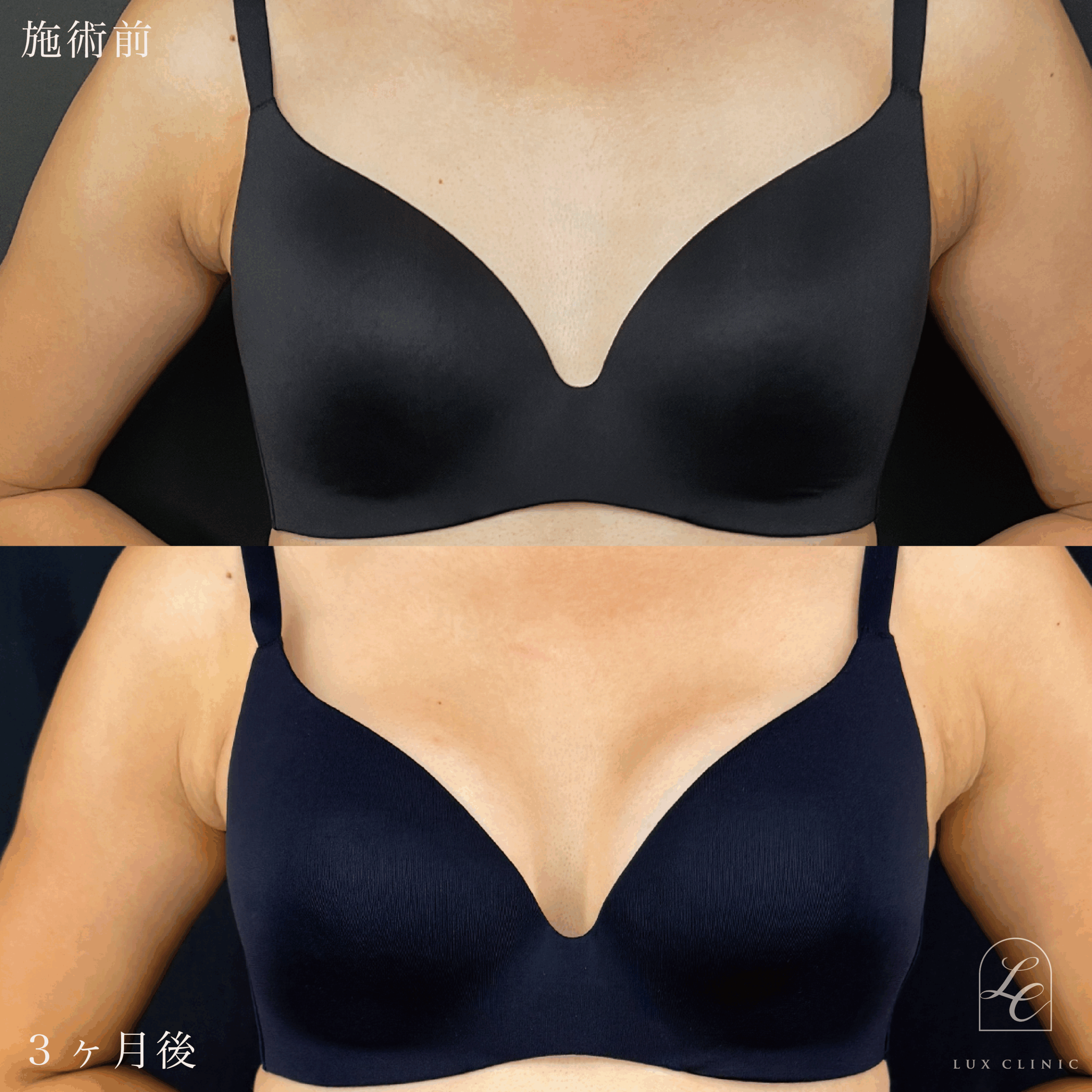 シリコンバッグ豊胸（乳腺下切開）motiva ergonomix2 210cc demi