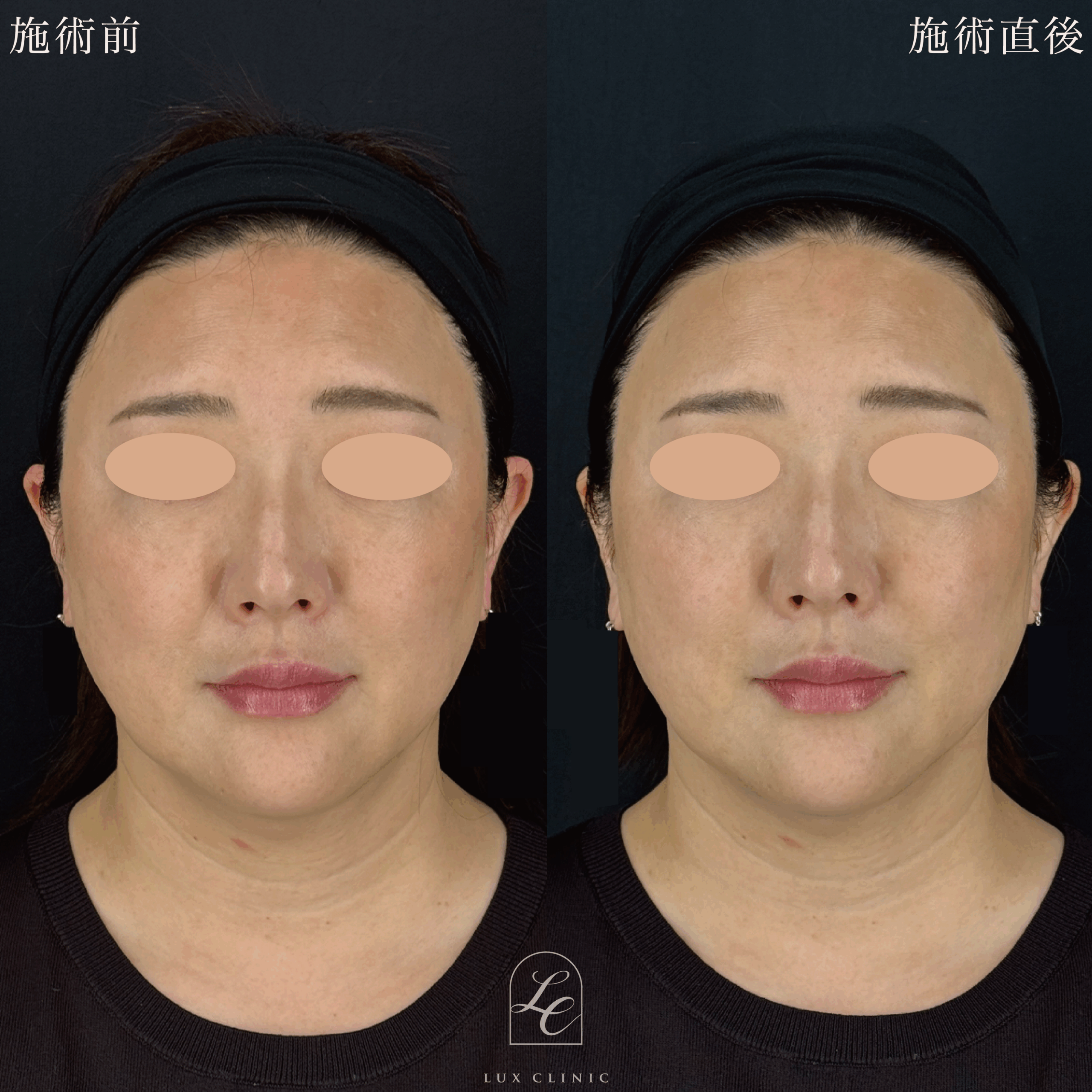 ヒアルロン酸（ニューラミス 1本）＜ほうれい線＞