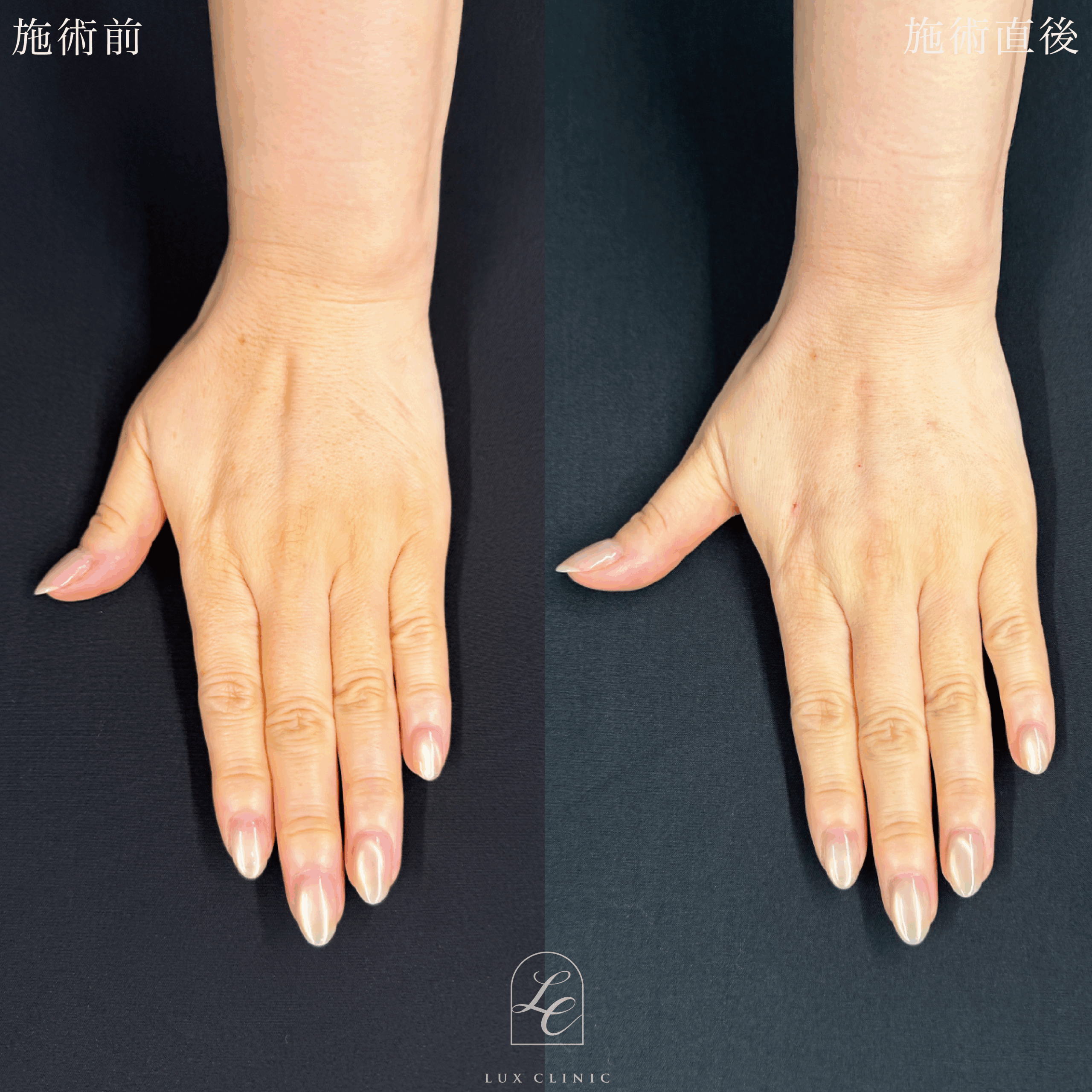 ヒアルロン酸（ニューラミス 1本）＜手の甲＞