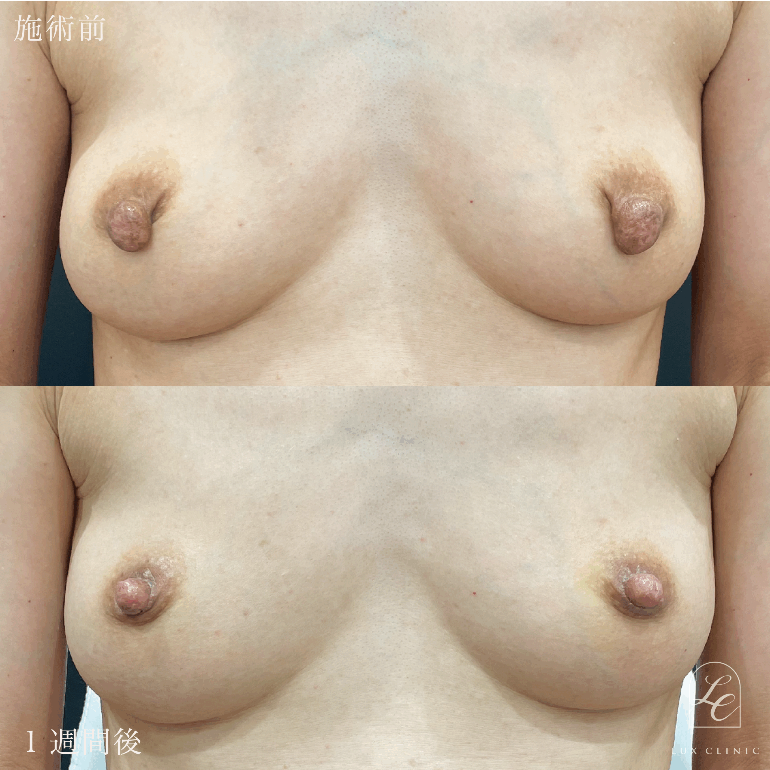 乳頭縮小術（乳管温存あり）