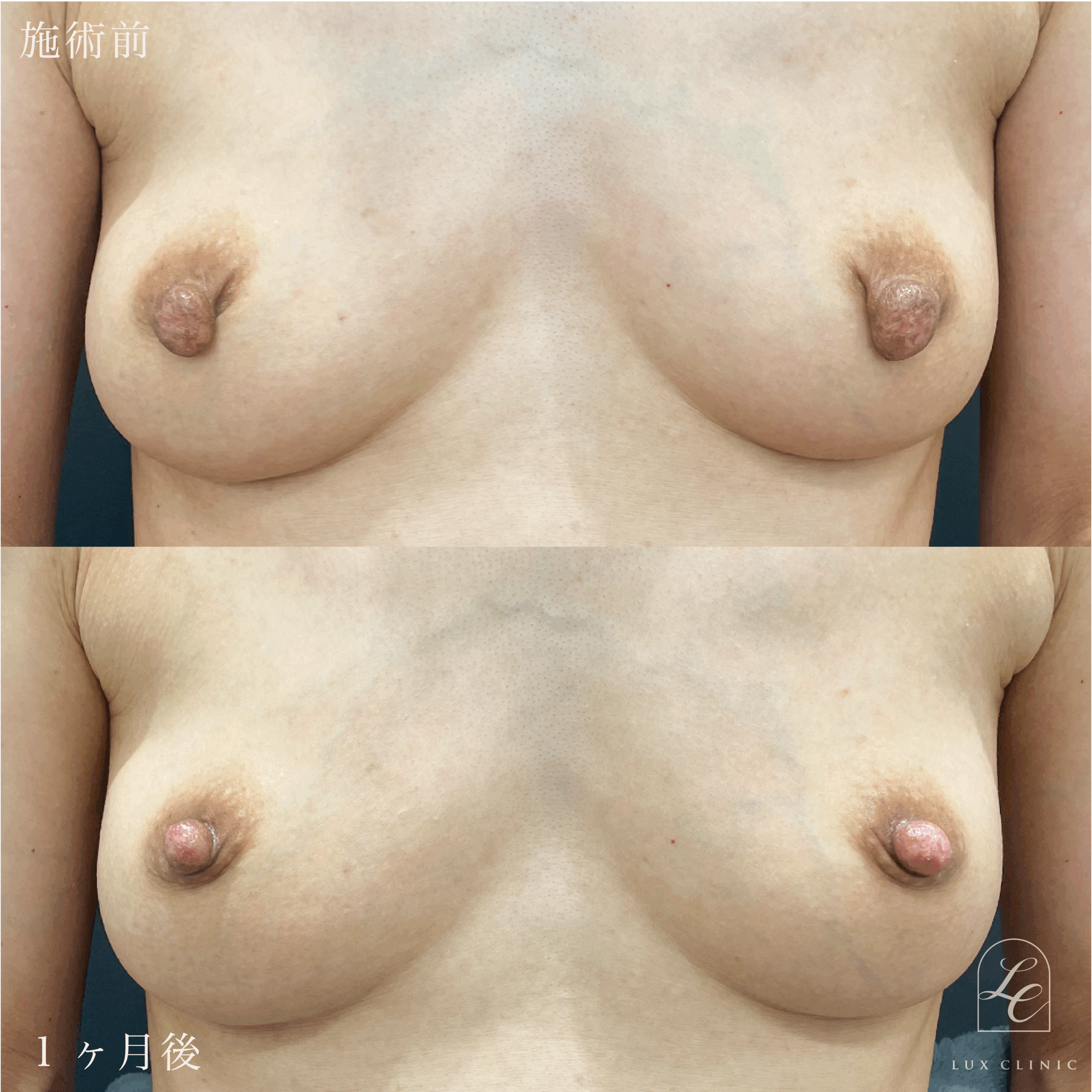 乳頭縮小術（乳管温存あり）