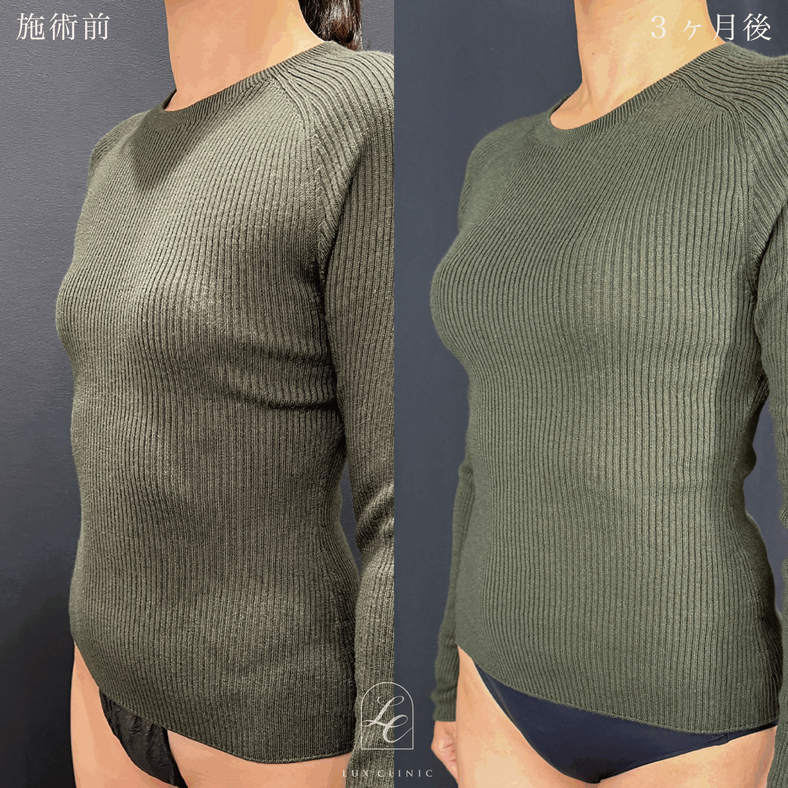 シリコンバッグ豊胸（乳腺下切開）motiva ergonomix2 210cc demi