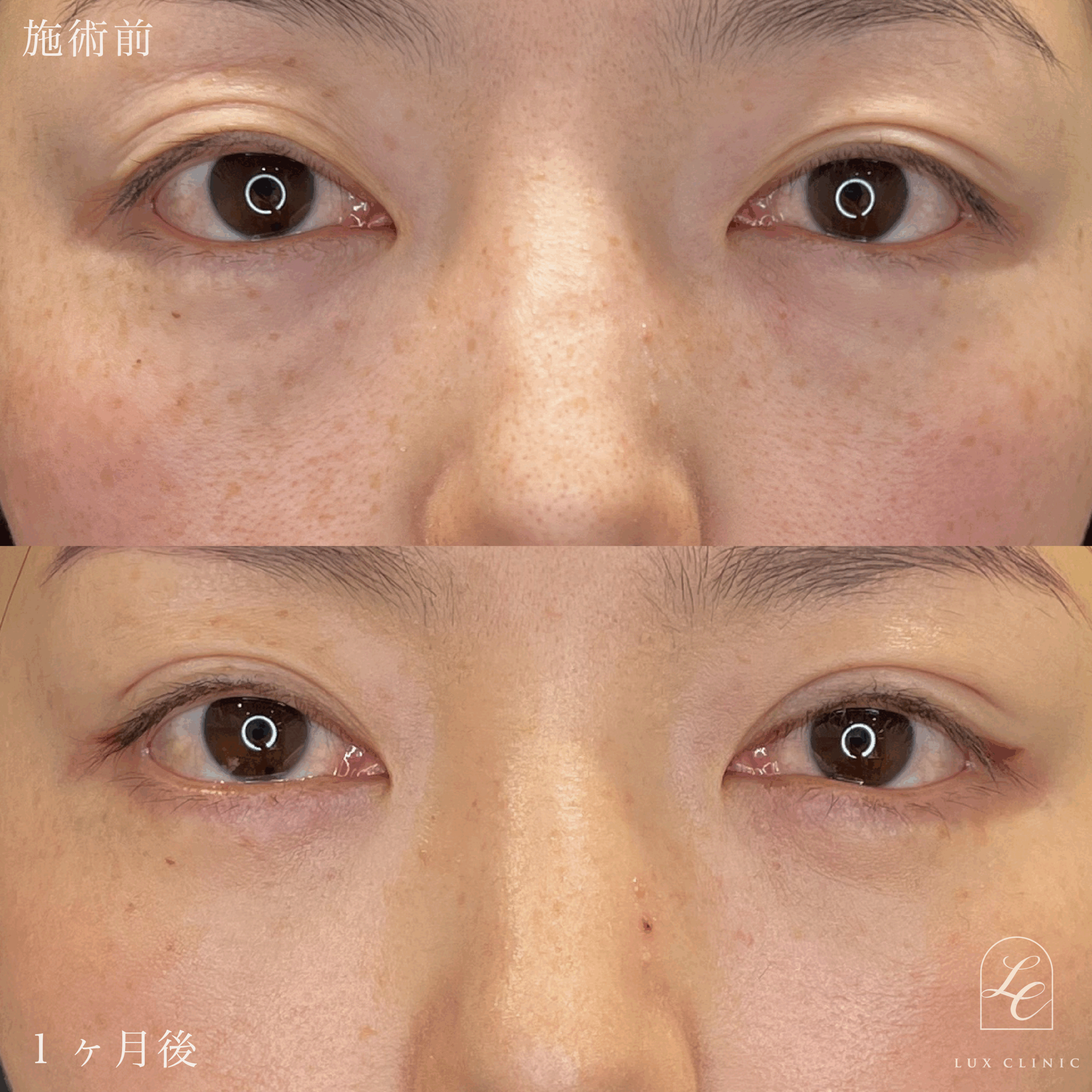 二重埋没法（クイックベーシック法 3点留め） ＋ 目の下のクマ取り、ふくらみ取り（脱脂）術