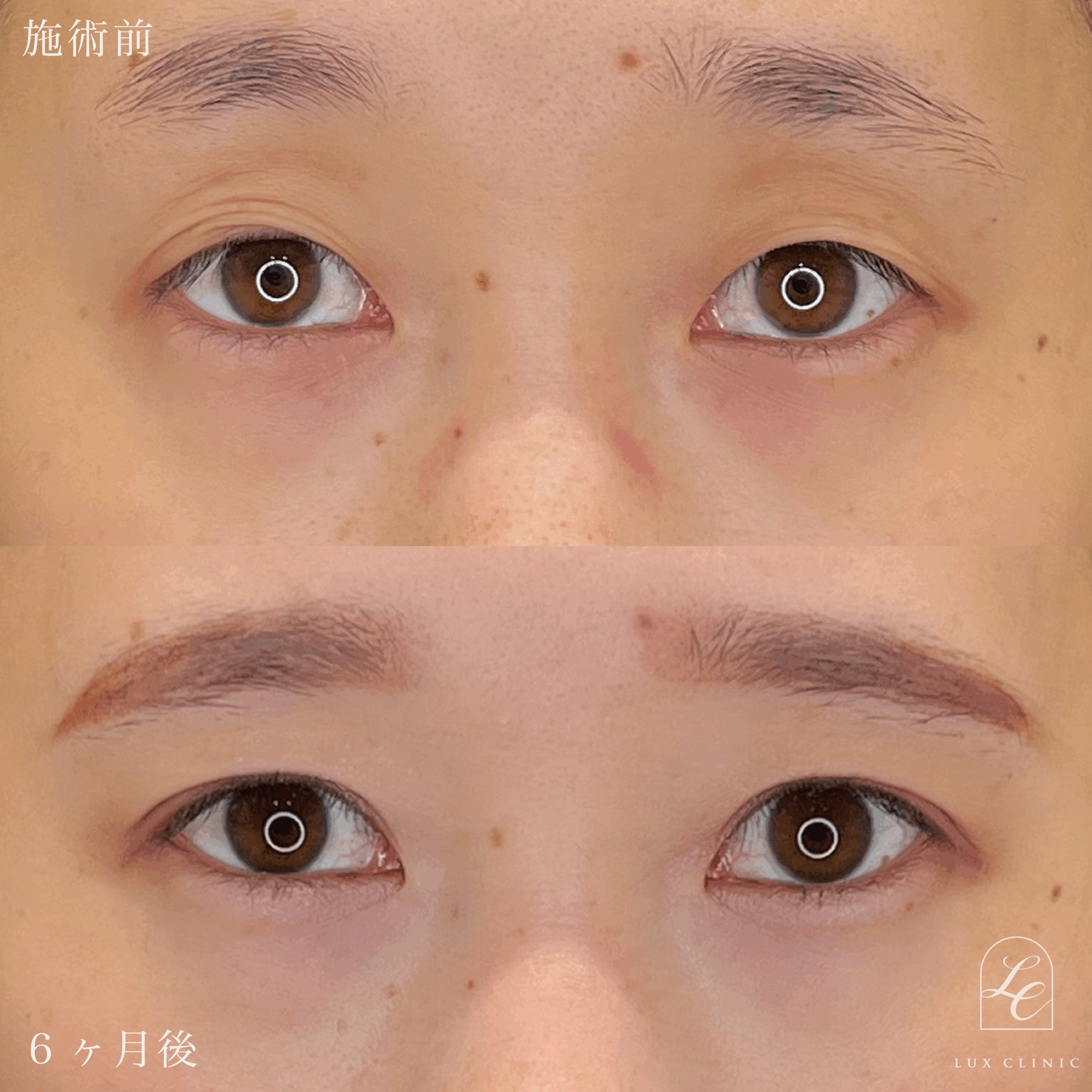 二重埋没法（クイックベーシック法 3点留め）