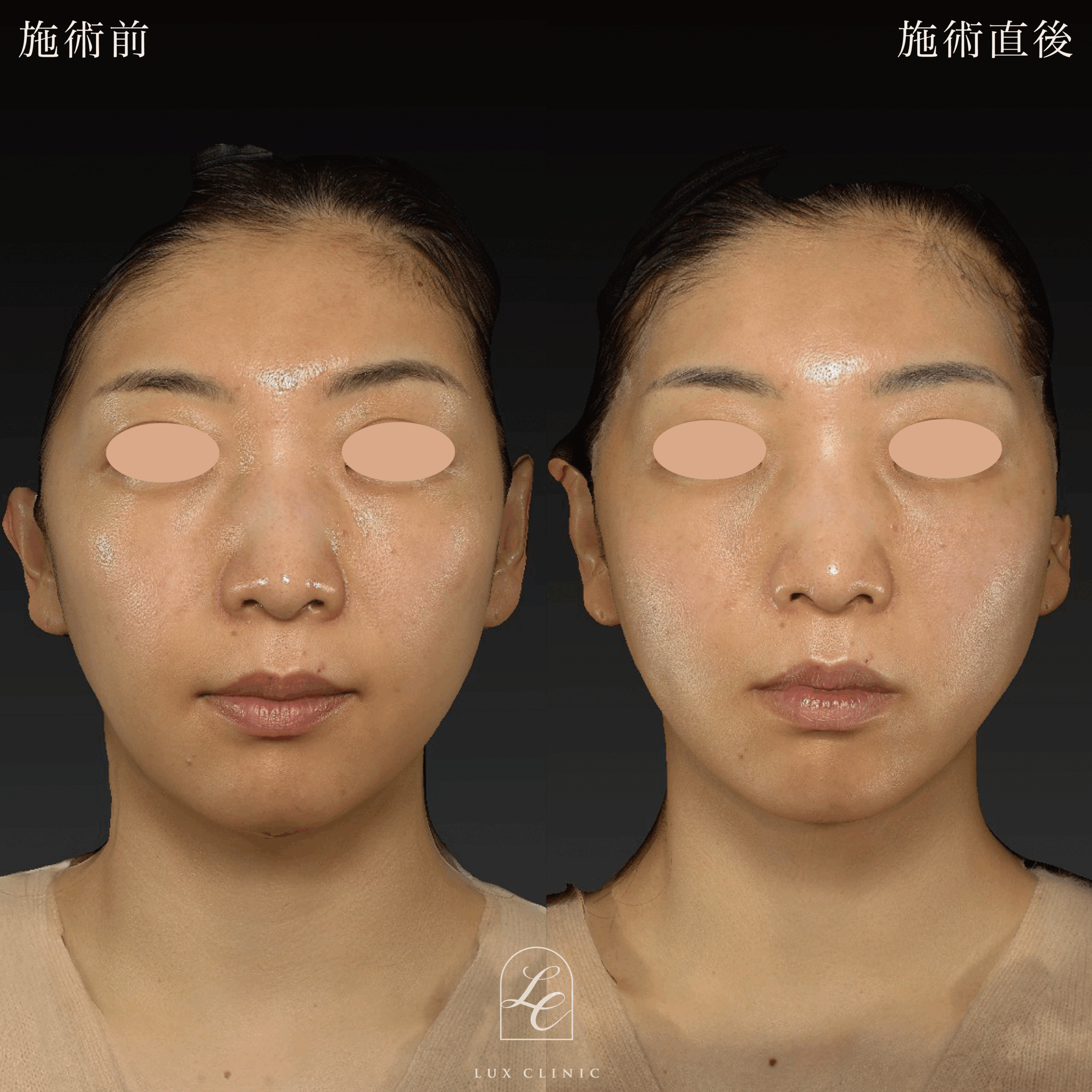 糸リフト（テスリフト 6本）