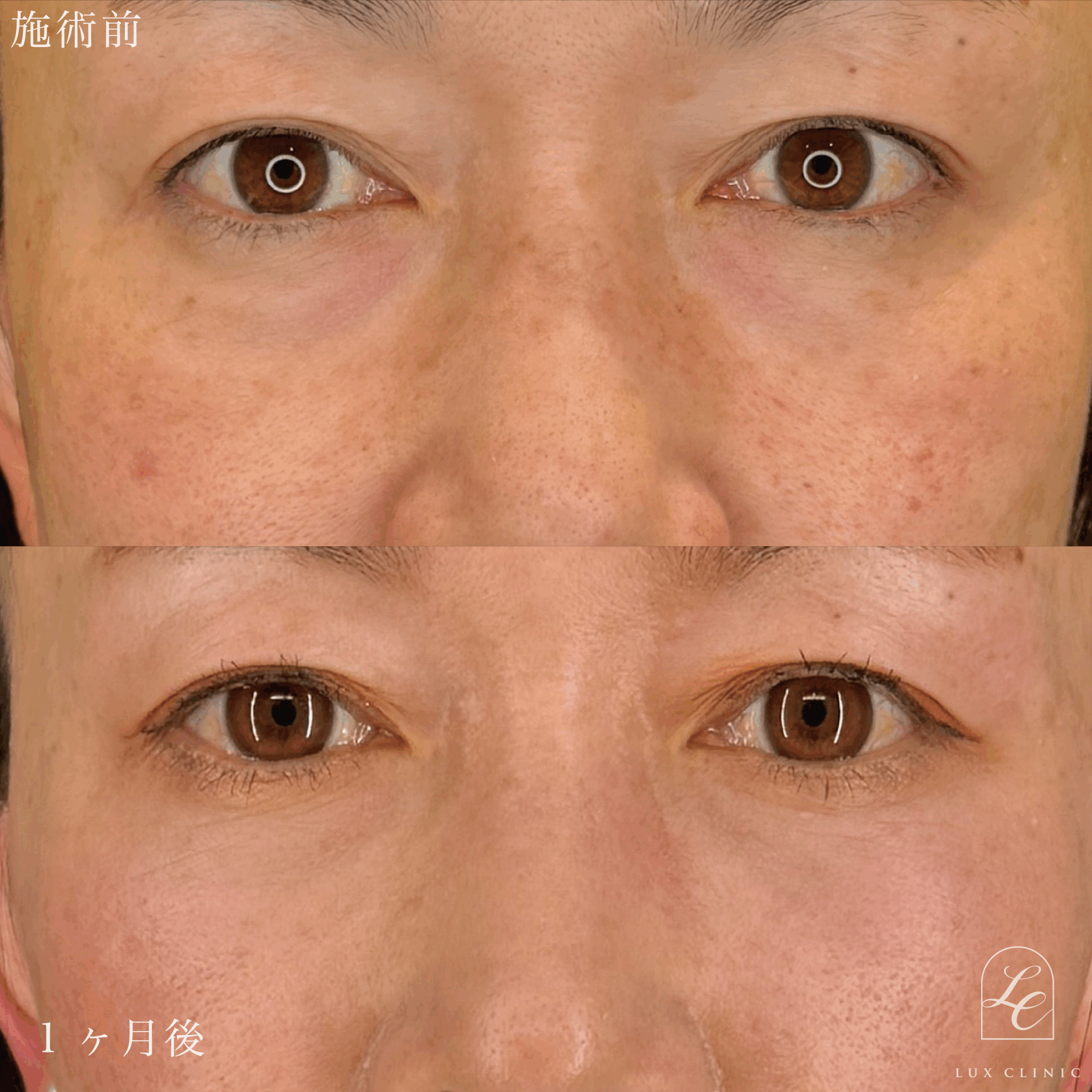 裏ハムラ法