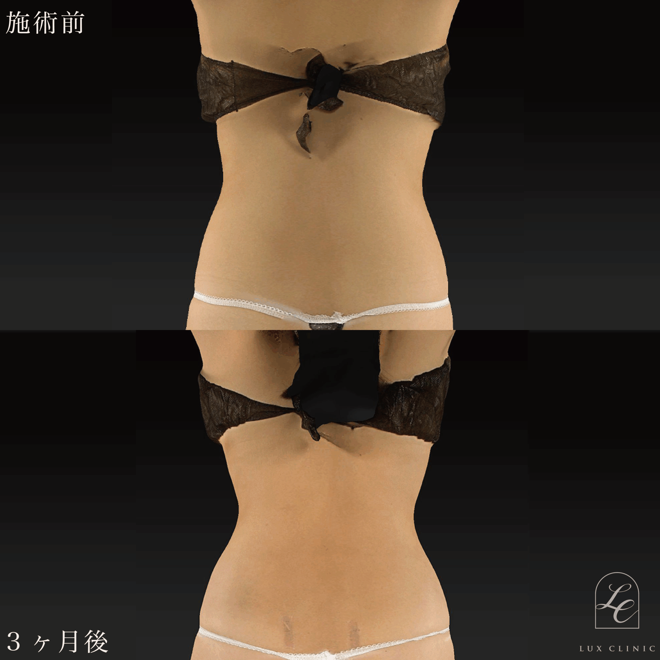 Ultra-Z 脂肪吸引 ＜腹部全面（上・下）・脇腹（前・後）・腰＞