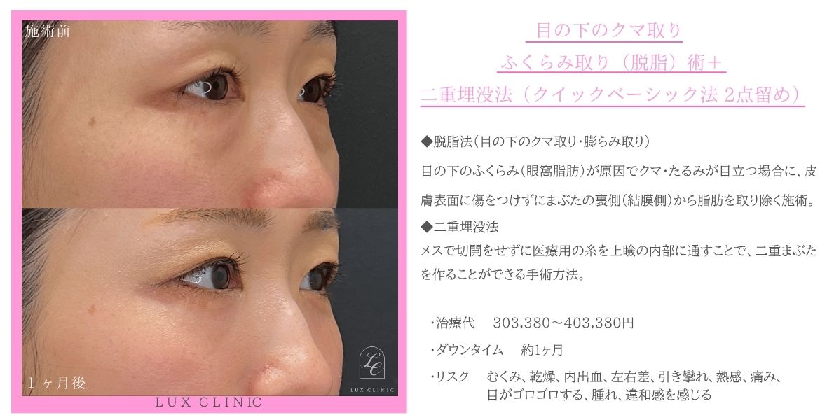目の下のクマ取り、ふくらみ取り（脱脂）術 ＋ 二重埋没法（クイックベーシック法 2点留め）