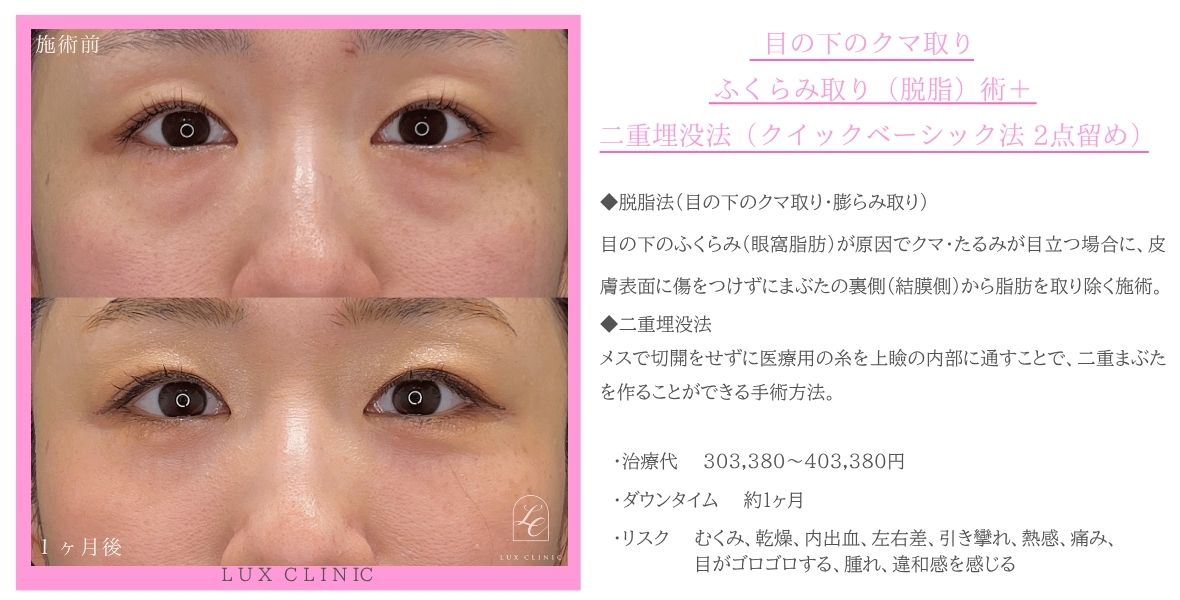 目の下のクマ取り、ふくらみ取り（脱脂）術 ＋ 二重埋没法（クイックベーシック法 2点留め）