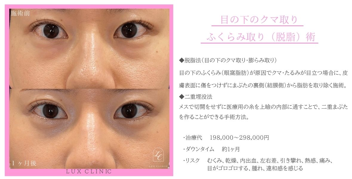 目の下のクマ取り、ふくらみ取り（脱脂）術