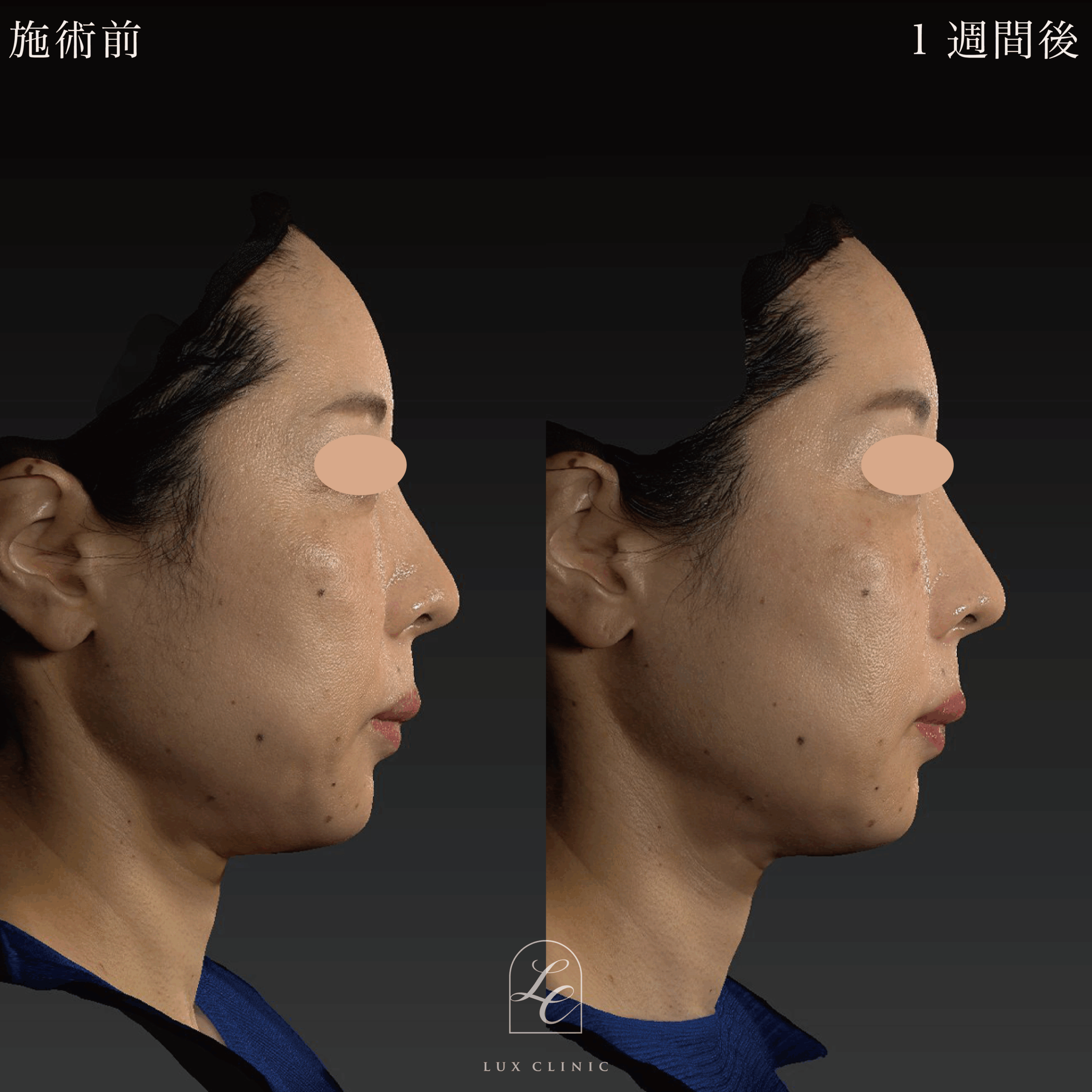 糸リフト（テスリフト 6本）