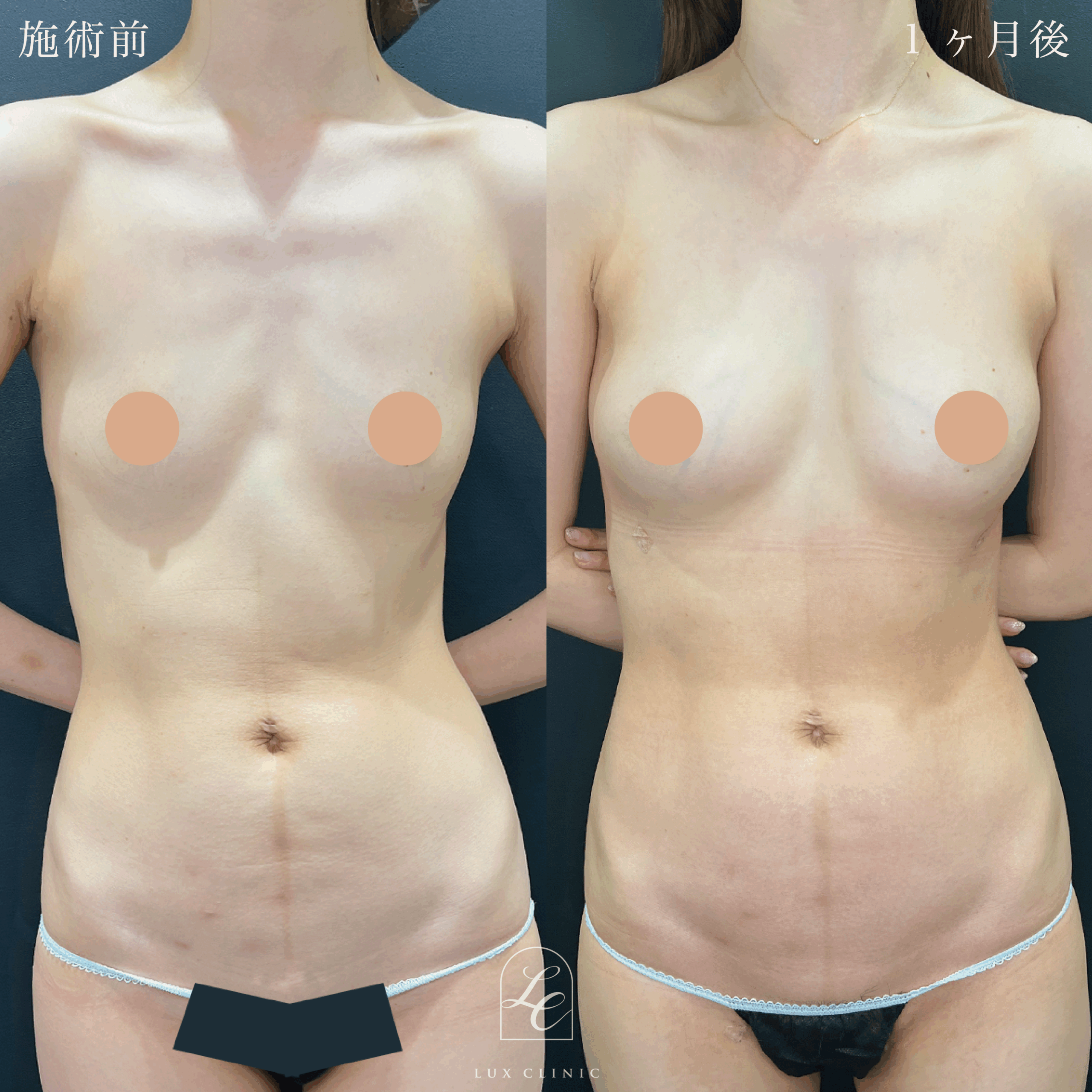 コンデンスリッチ脂肪注入豊胸 （脂肪採取部位：太腿内側）