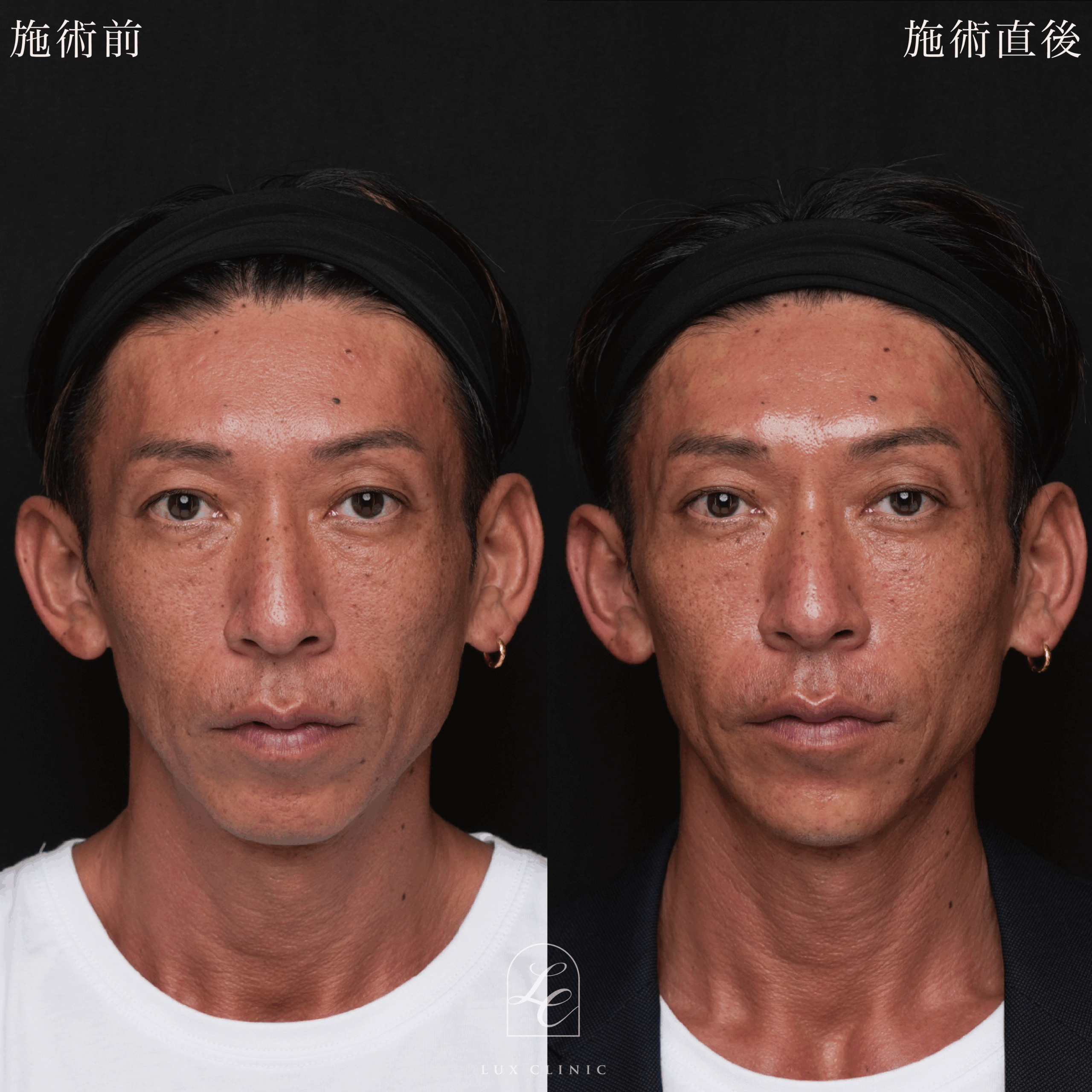 HIFU＜全顔、目周り＞＋ボルニューマー＜全顔＞＋ヒアルロン酸（レスチレン 3本）＜こめかみ、あご、ほうれい線＞