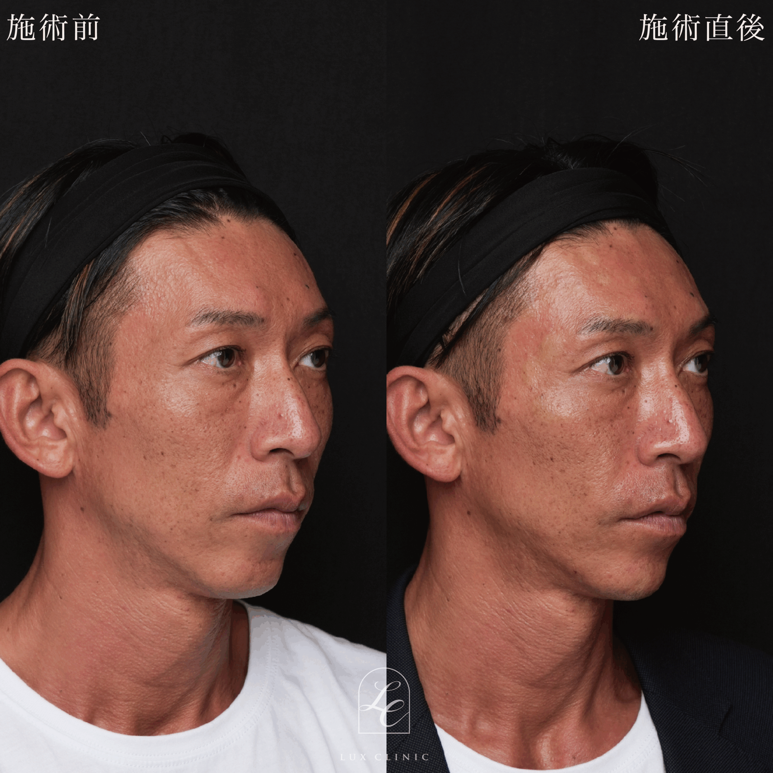 HIFU＜全顔、目周り＞＋ボルニューマー＜全顔＞＋ヒアルロン酸（レスチレン 3本）＜こめかみ、あご、ほうれい線＞