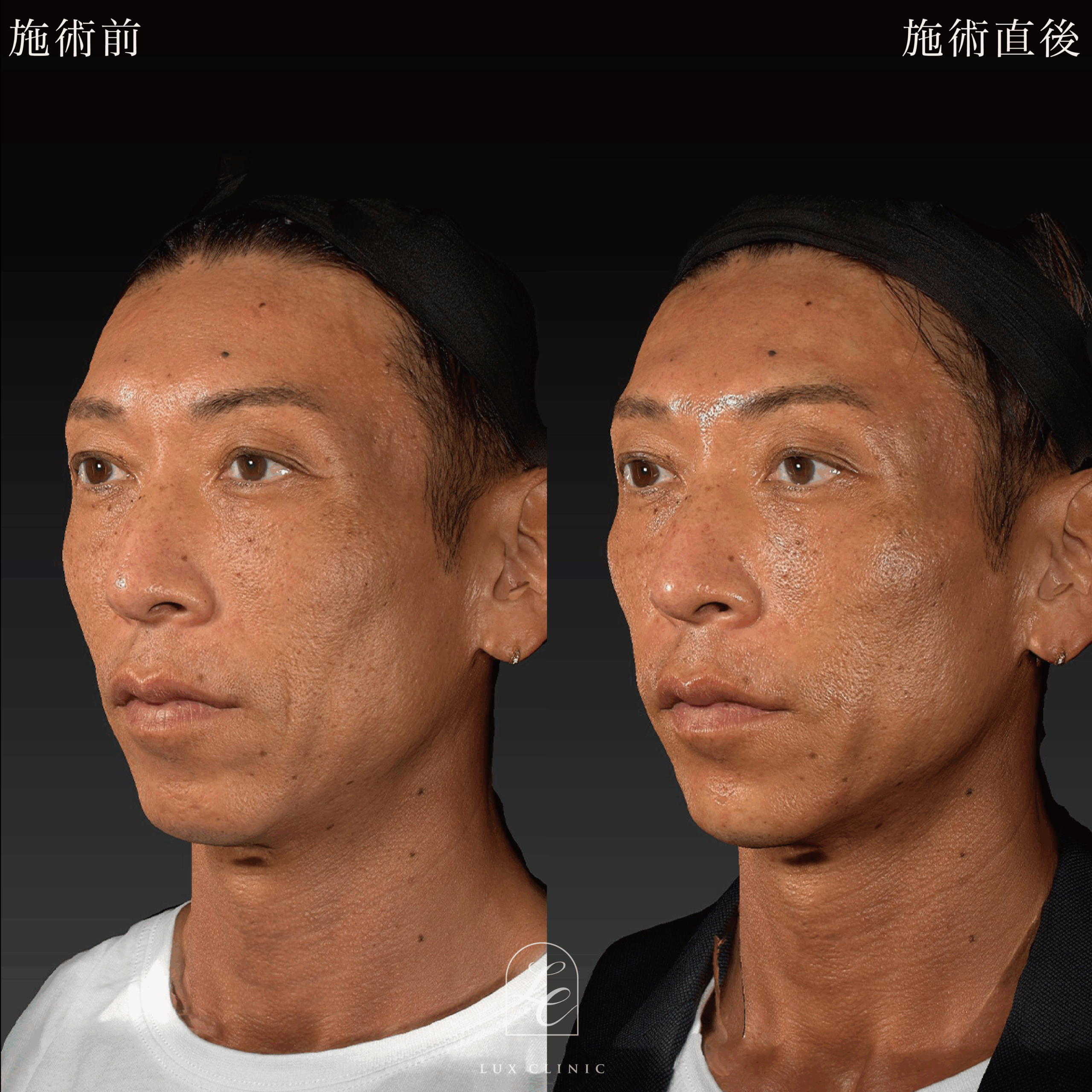 HIFU＜全顔、目周り＞＋ボルニューマー＜全顔＞＋ヒアルロン酸（レスチレン 3本）＜こめかみ、あご、ほうれい線＞