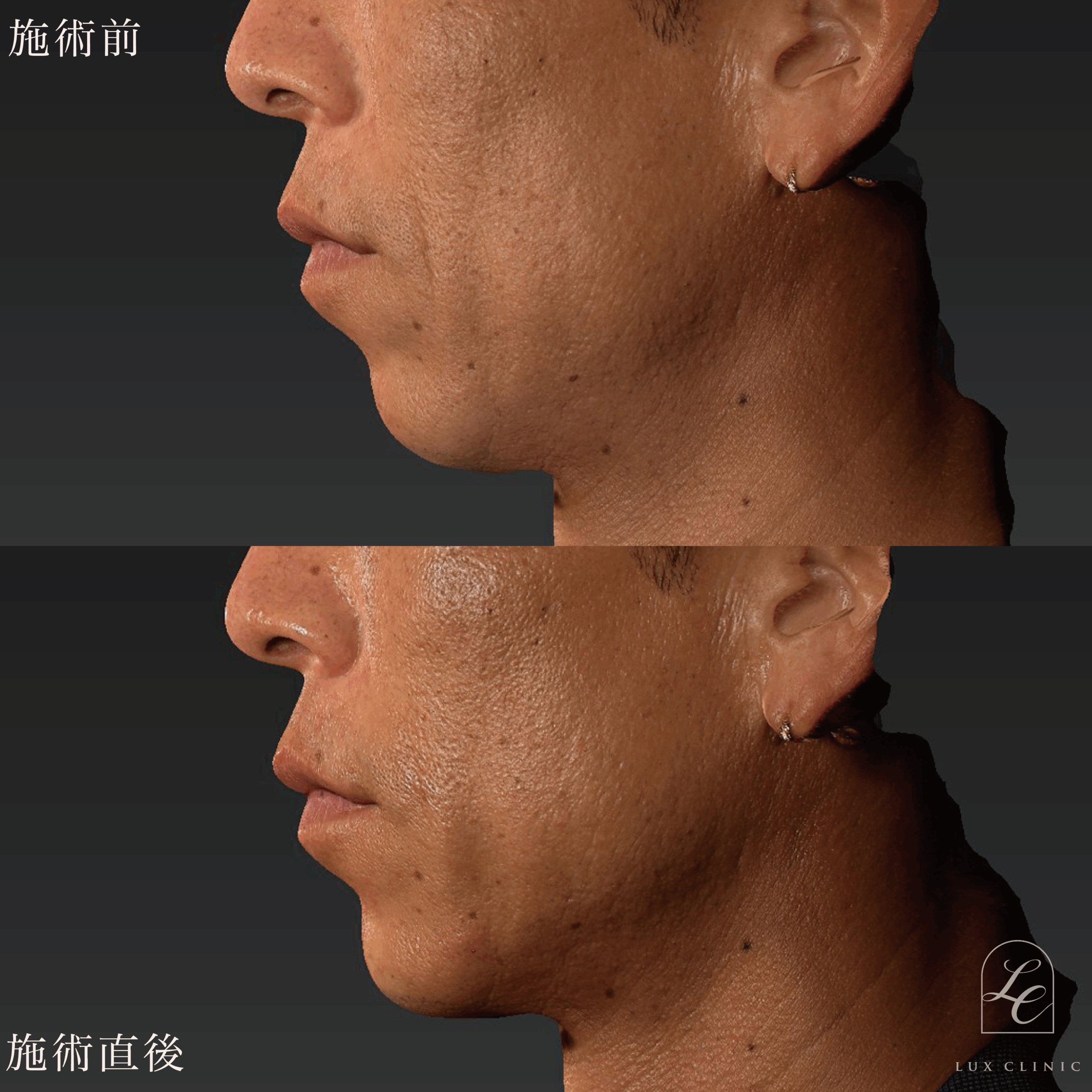 HIFU＜全顔、目周り＞＋ボルニューマー＜全顔＞＋ヒアルロン酸（レスチレン 3本）＜こめかみ、あご、ほうれい線＞