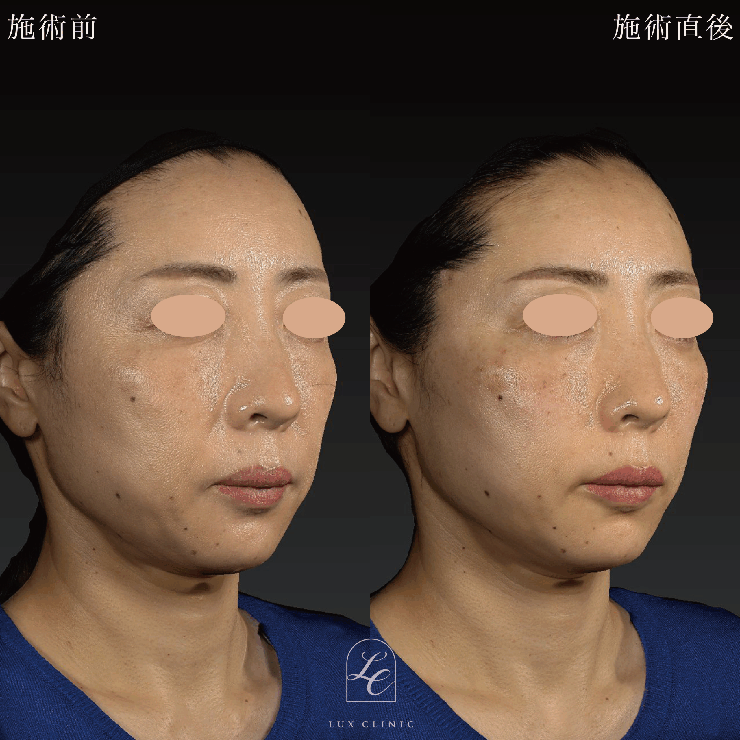 糸リフト（テスリフト 6本）