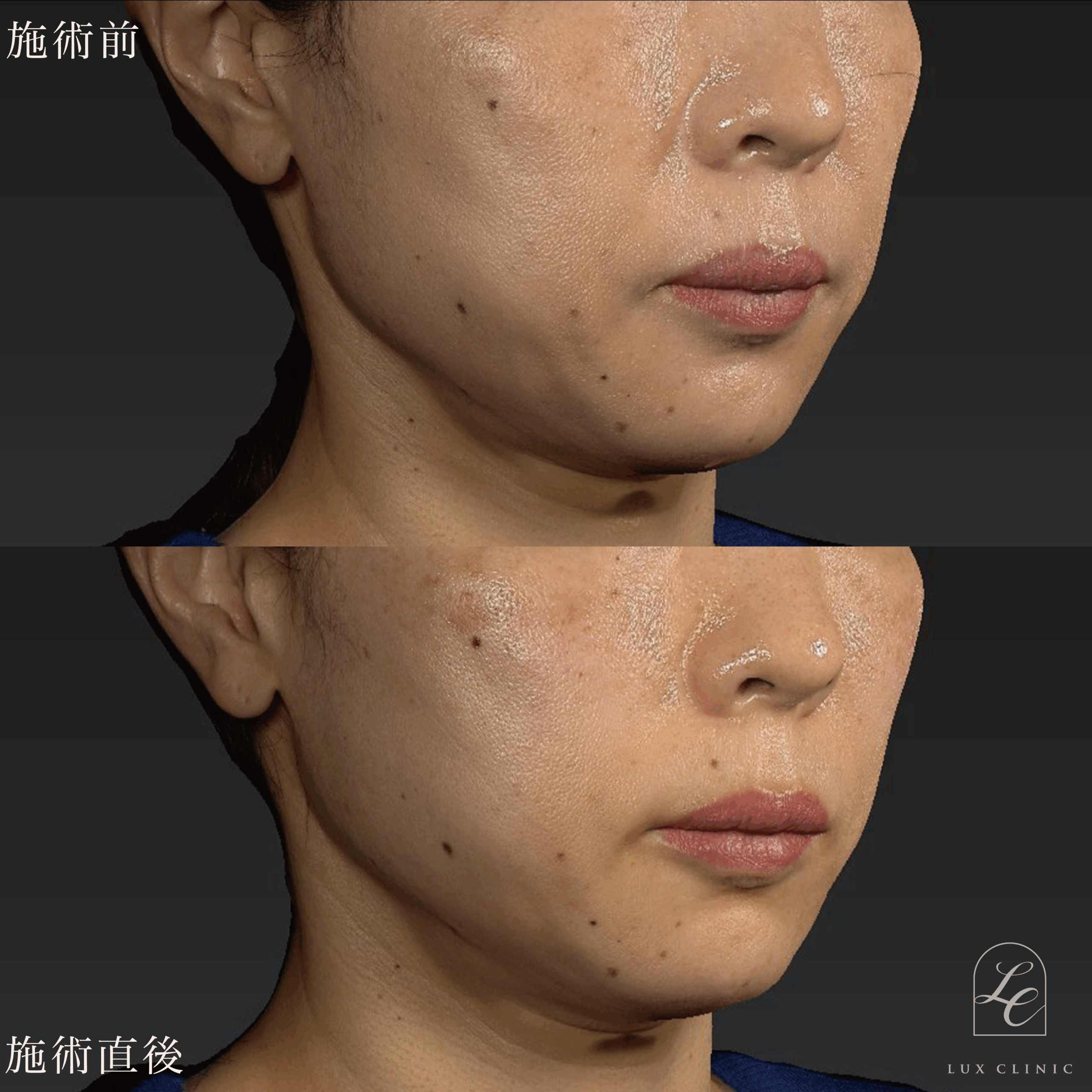 糸リフト（テスリフト 6本）