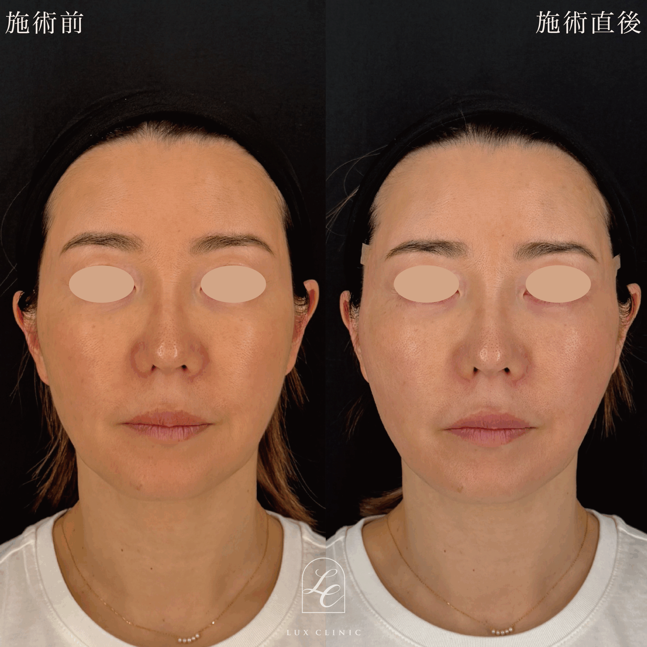 糸リフト（フィオラスレッドMolding Cog 6本）