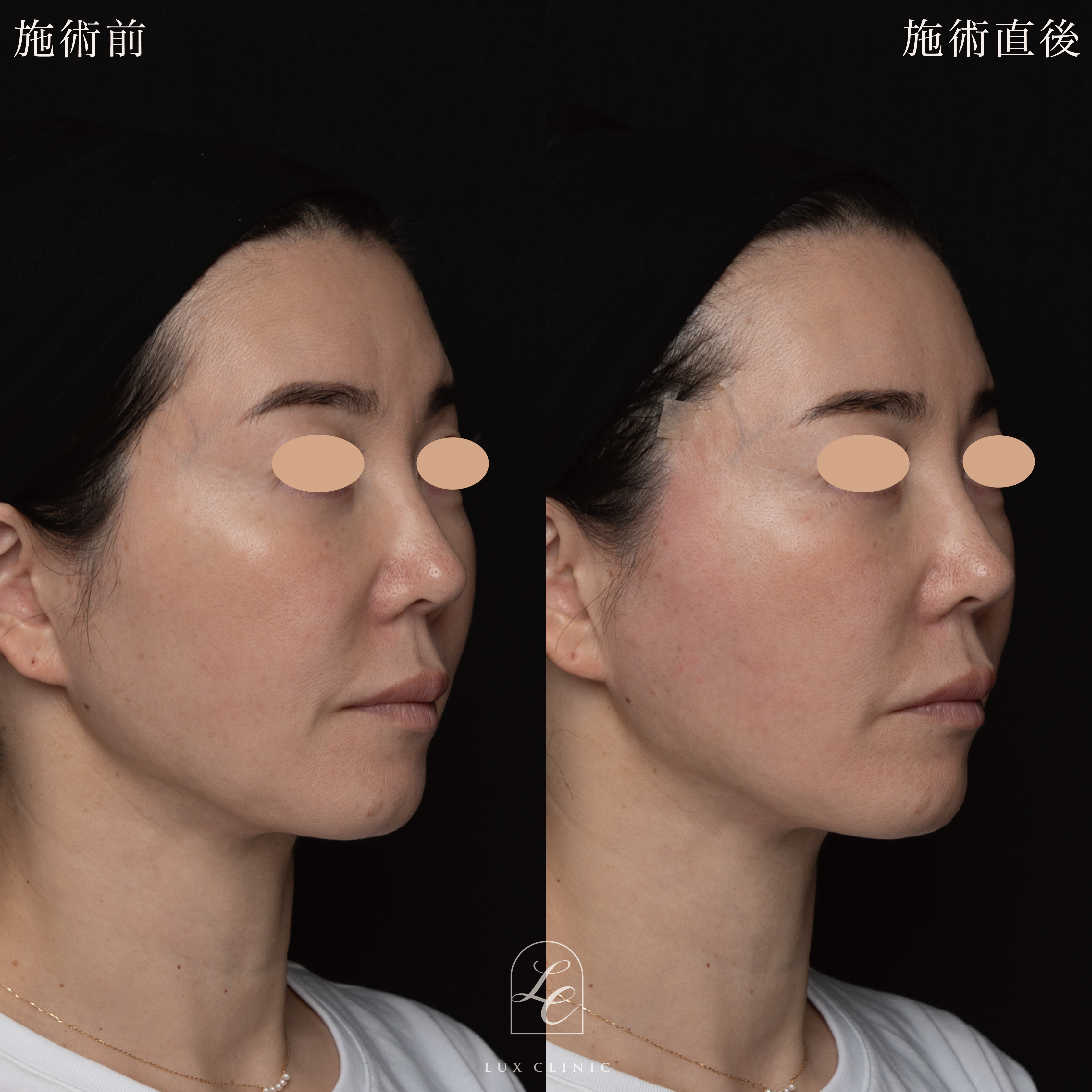 糸リフト（フィオラスレッドMolding Cog 6本）