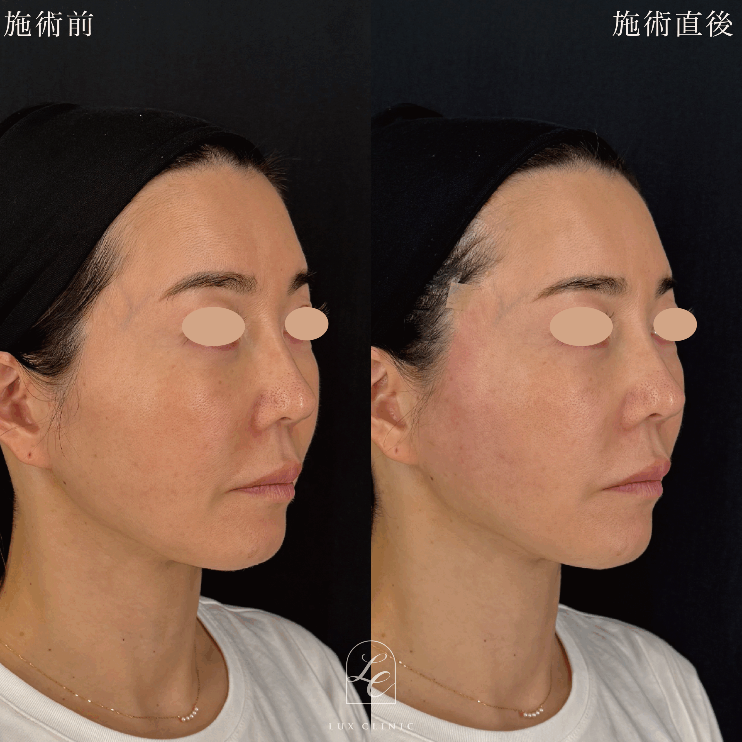 糸リフト（フィオラスレッドMolding Cog 6本）