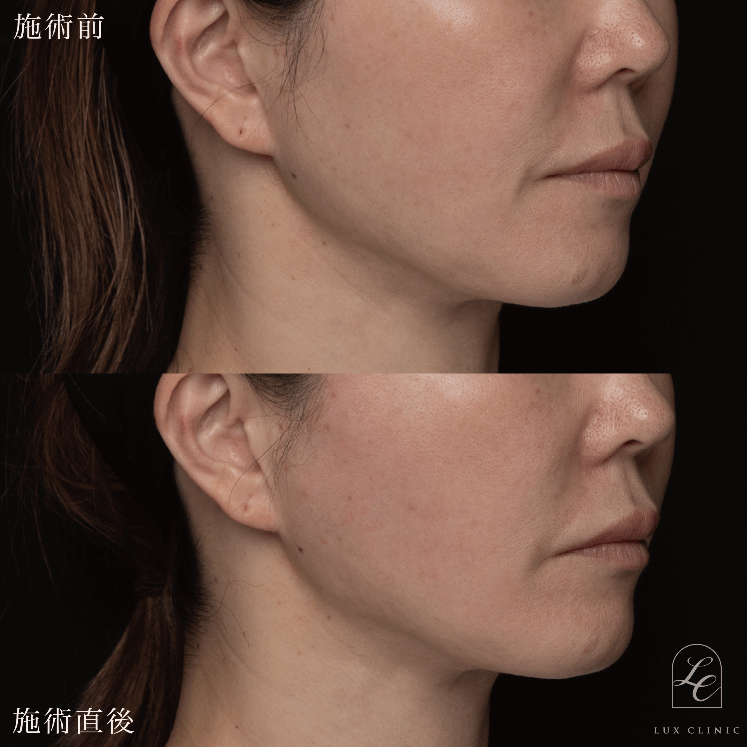 糸リフト（フィオラスレッドMolding Cog 6本）