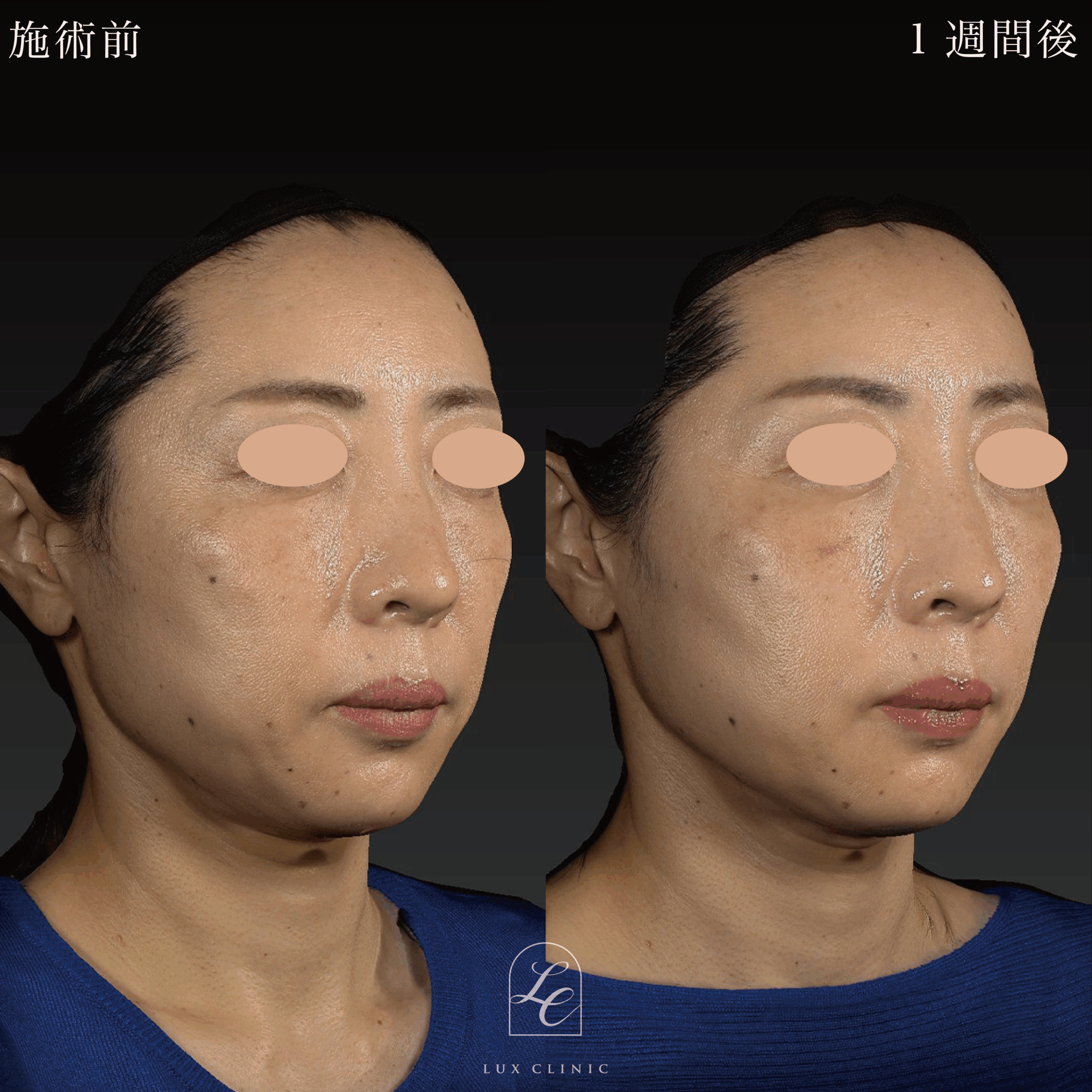 糸リフト（テスリフト 6本）