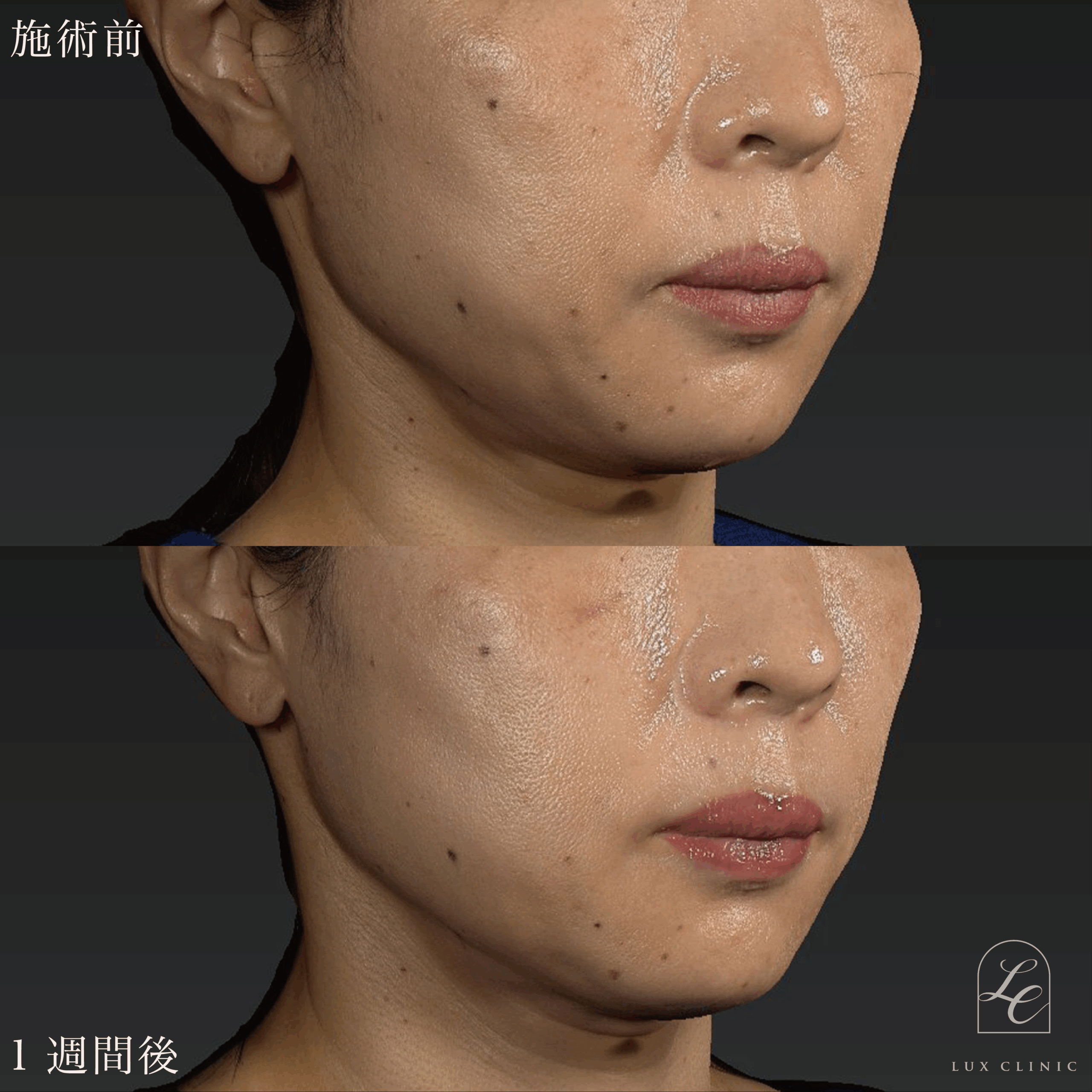 糸リフト（テスリフト 6本）