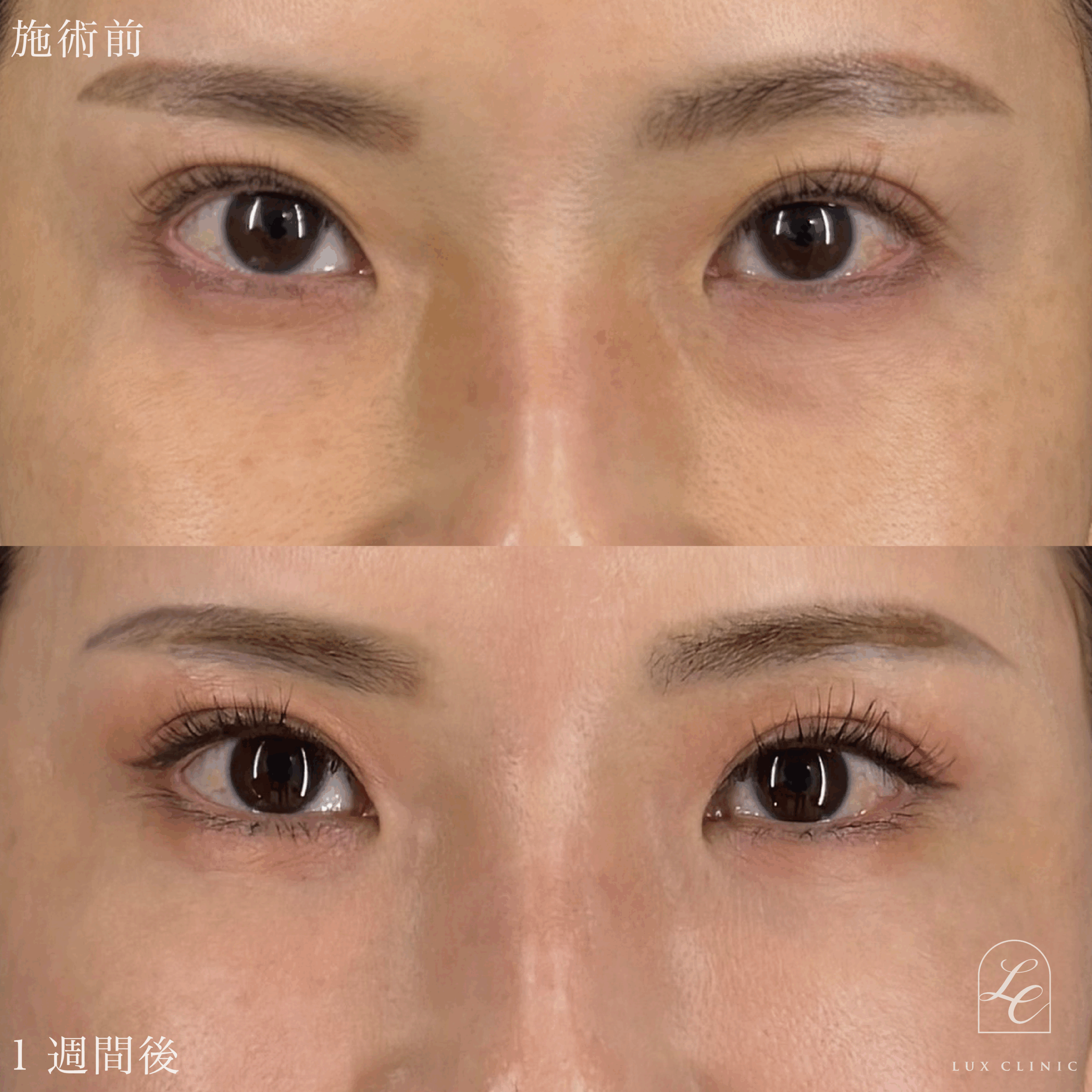 目の下のふくらみ取り（脱脂）術 ＋ヒアルロン酸（ニューラミス 2本）＜目の下、チーク部分＞