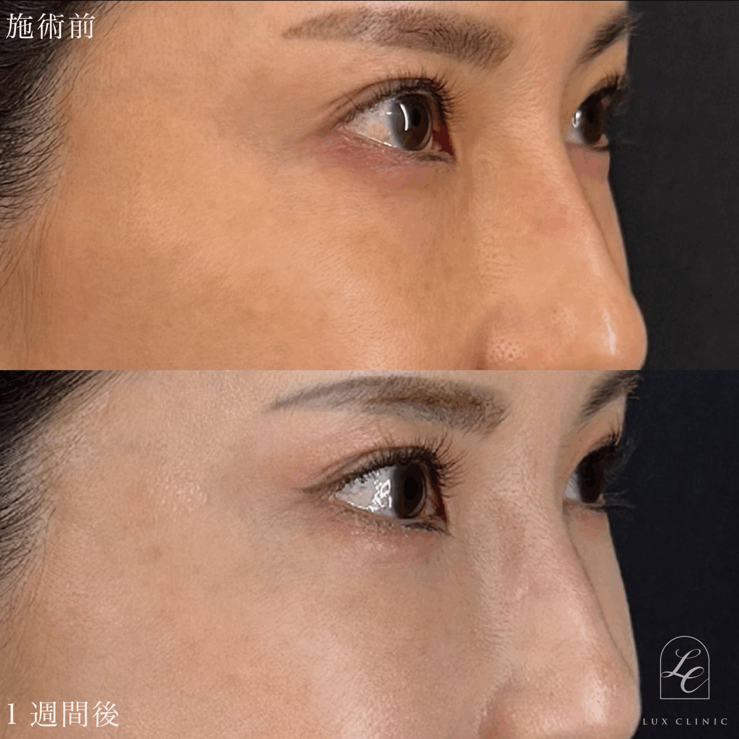 目の下のふくらみ取り（脱脂）術 ＋ヒアルロン酸（ニューラミス 2本）＜目の下、チーク部分＞