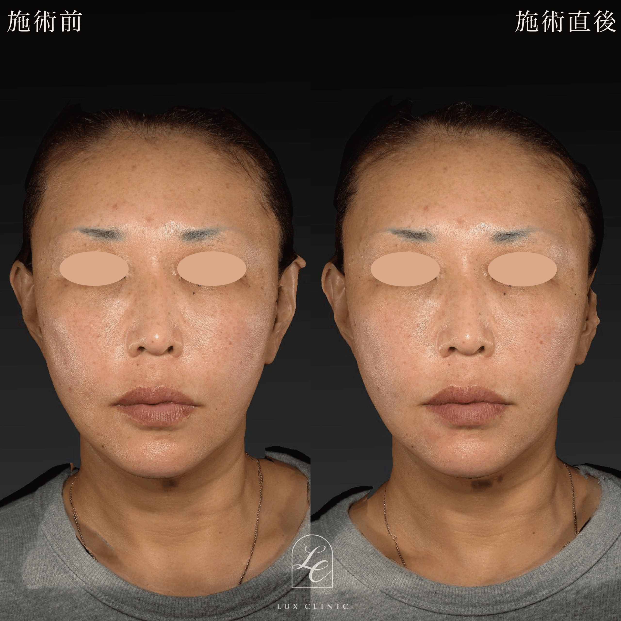 ヒアルロン酸（ニューラミス 2本）＜口横、頬＞