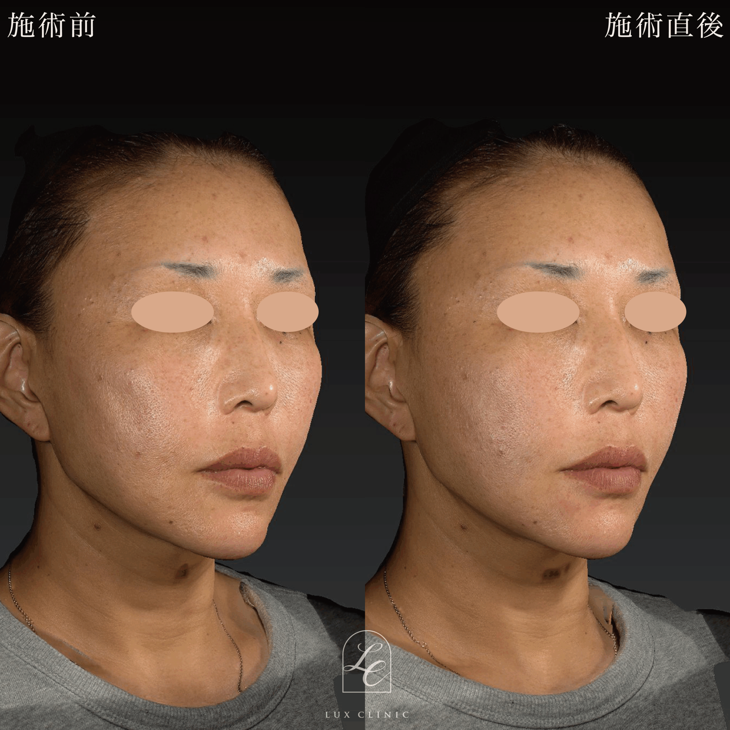 ヒアルロン酸（ニューラミス 2本）＜口横、頬＞