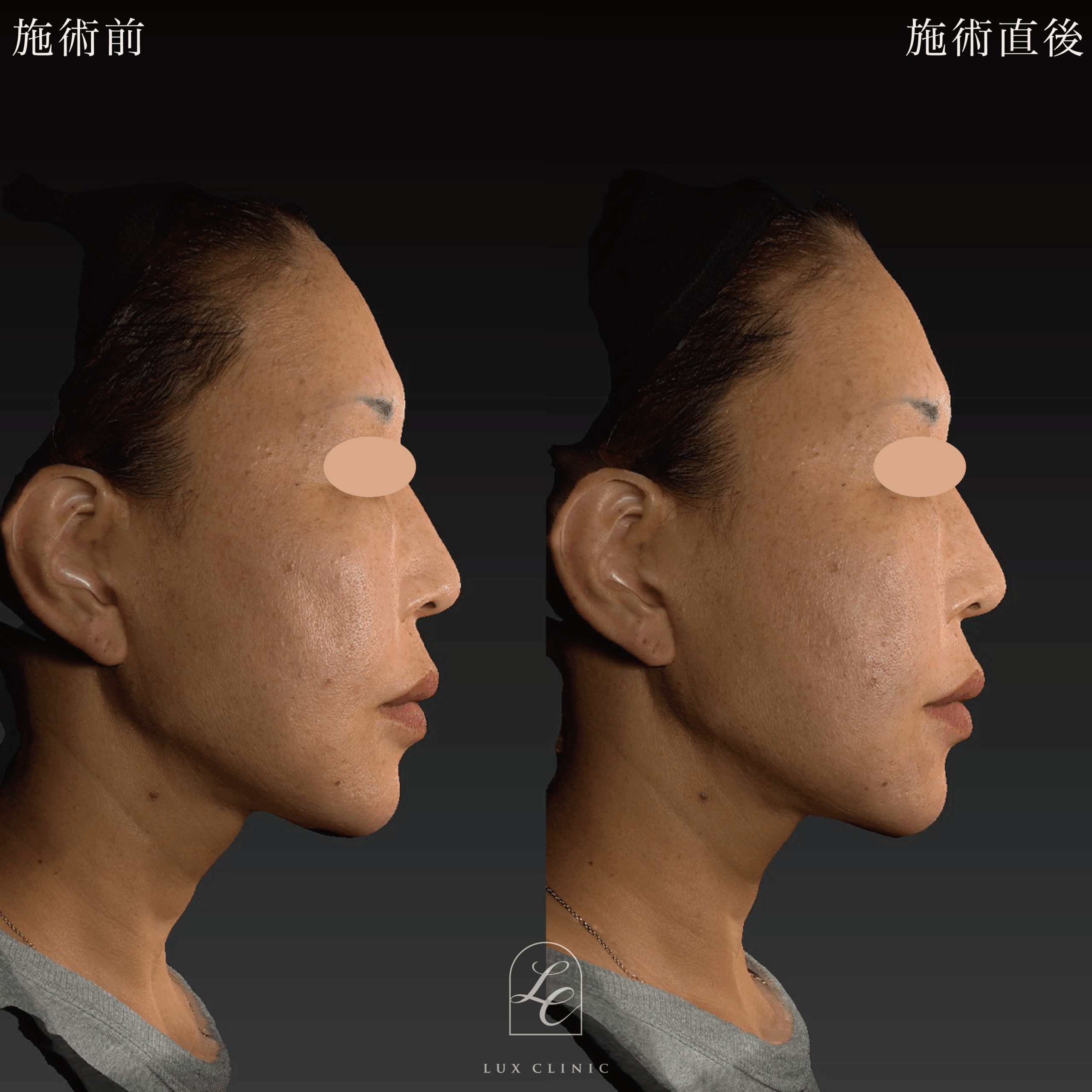 ヒアルロン酸（ニューラミス 2本）＜口横、頬＞