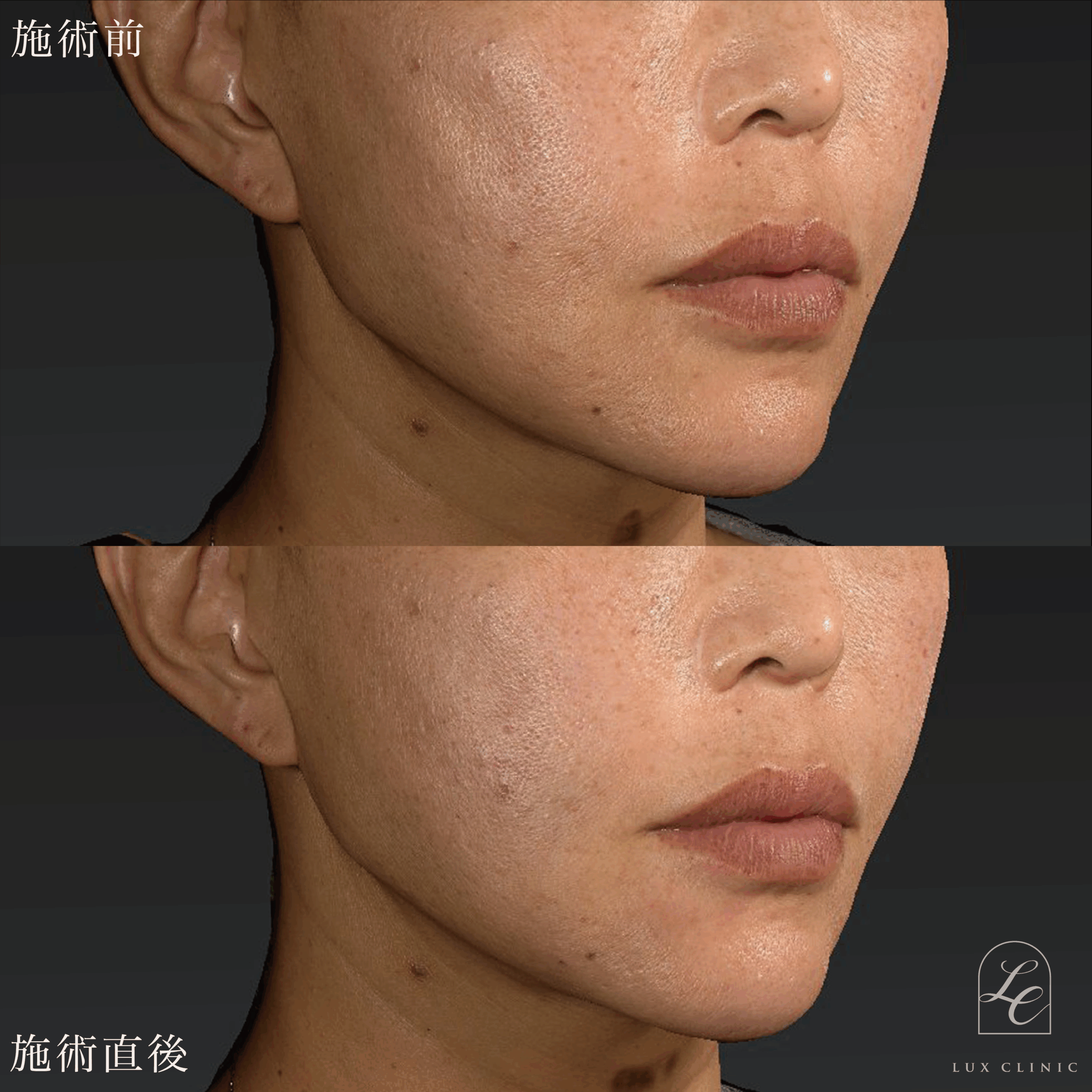 ヒアルロン酸（ニューラミス 2本）＜口横、頬＞