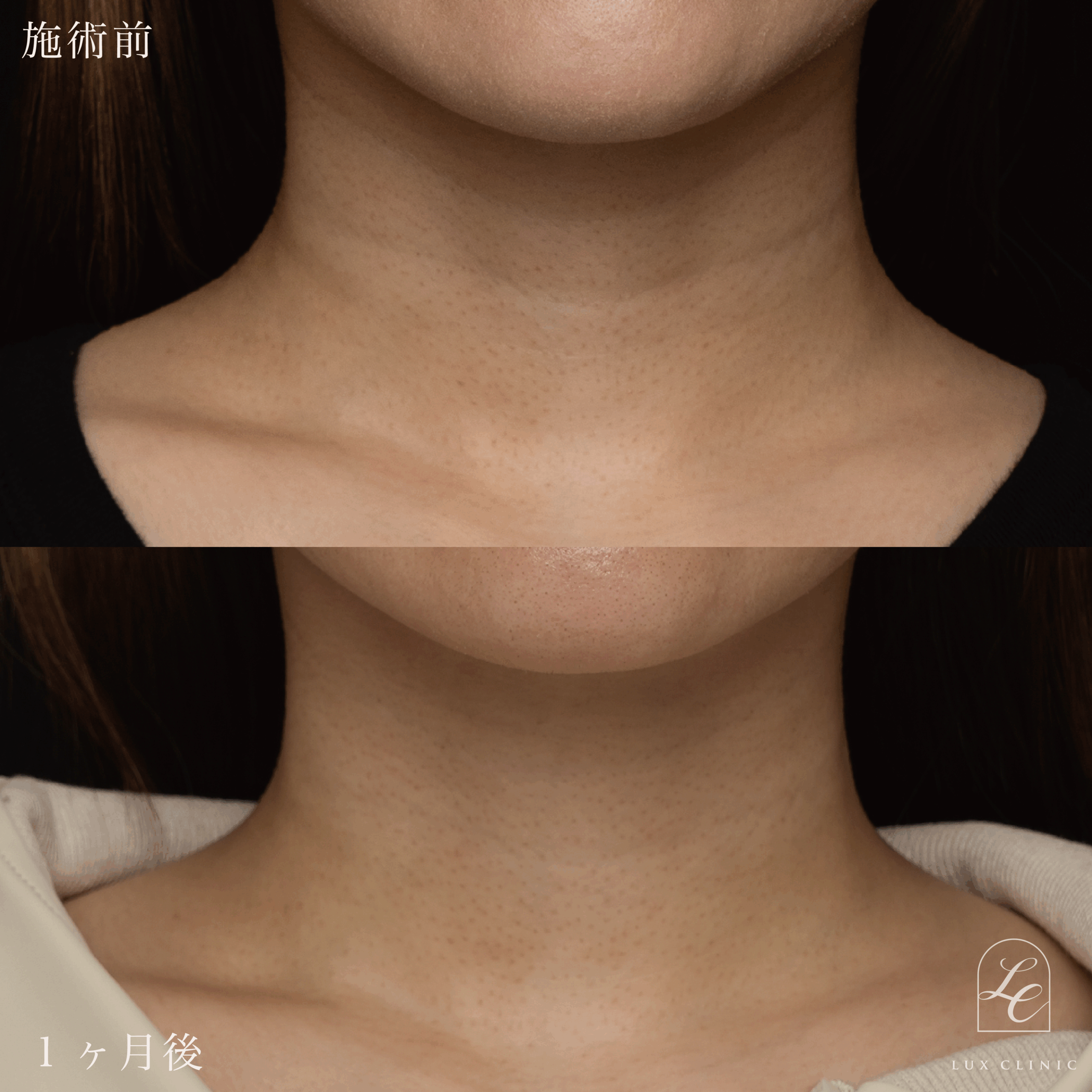 プルリアル バイオスカルプチャー2.2cc ＜首＞