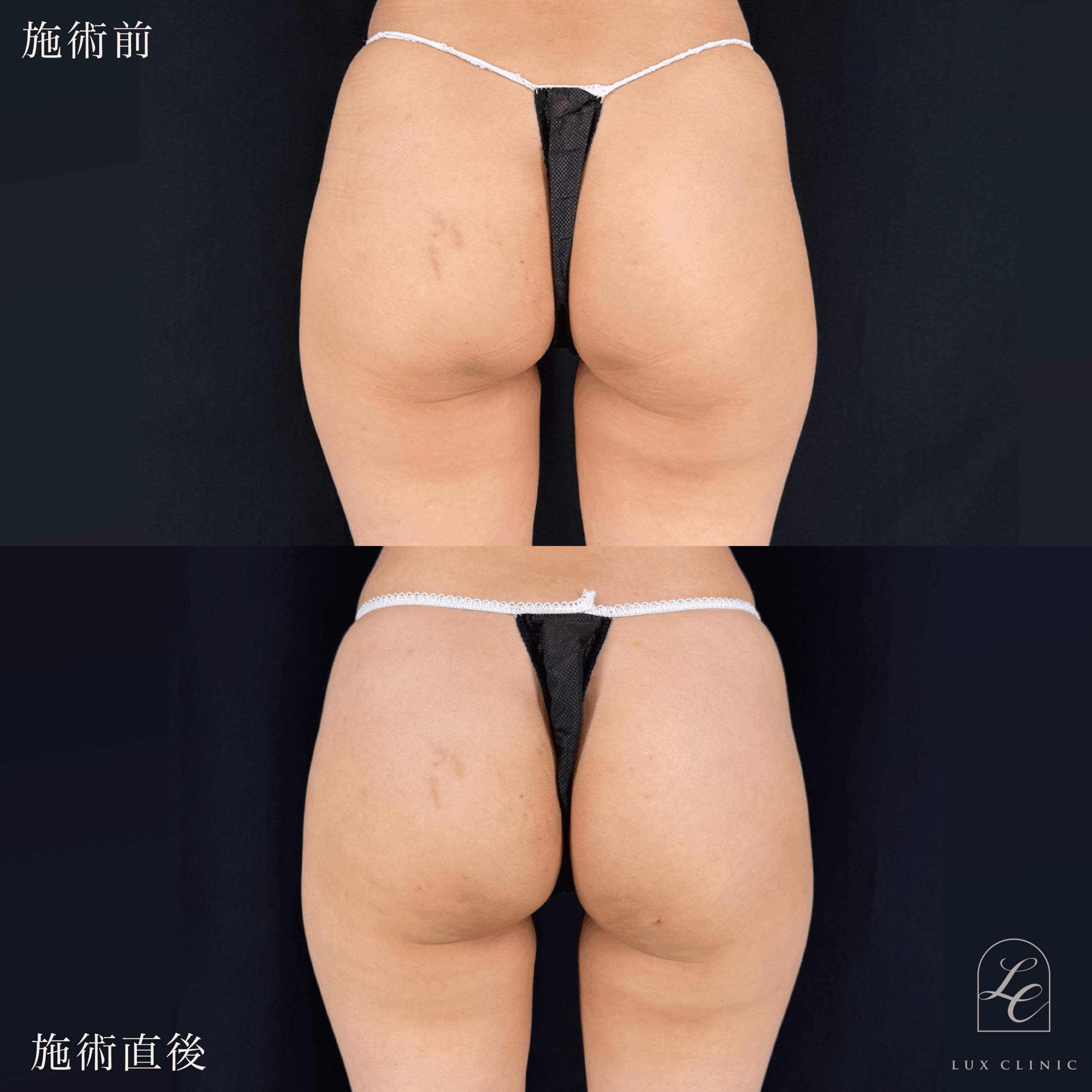 ヒアルロン酸（ヴィーナフィル 10cc）＜お尻＞