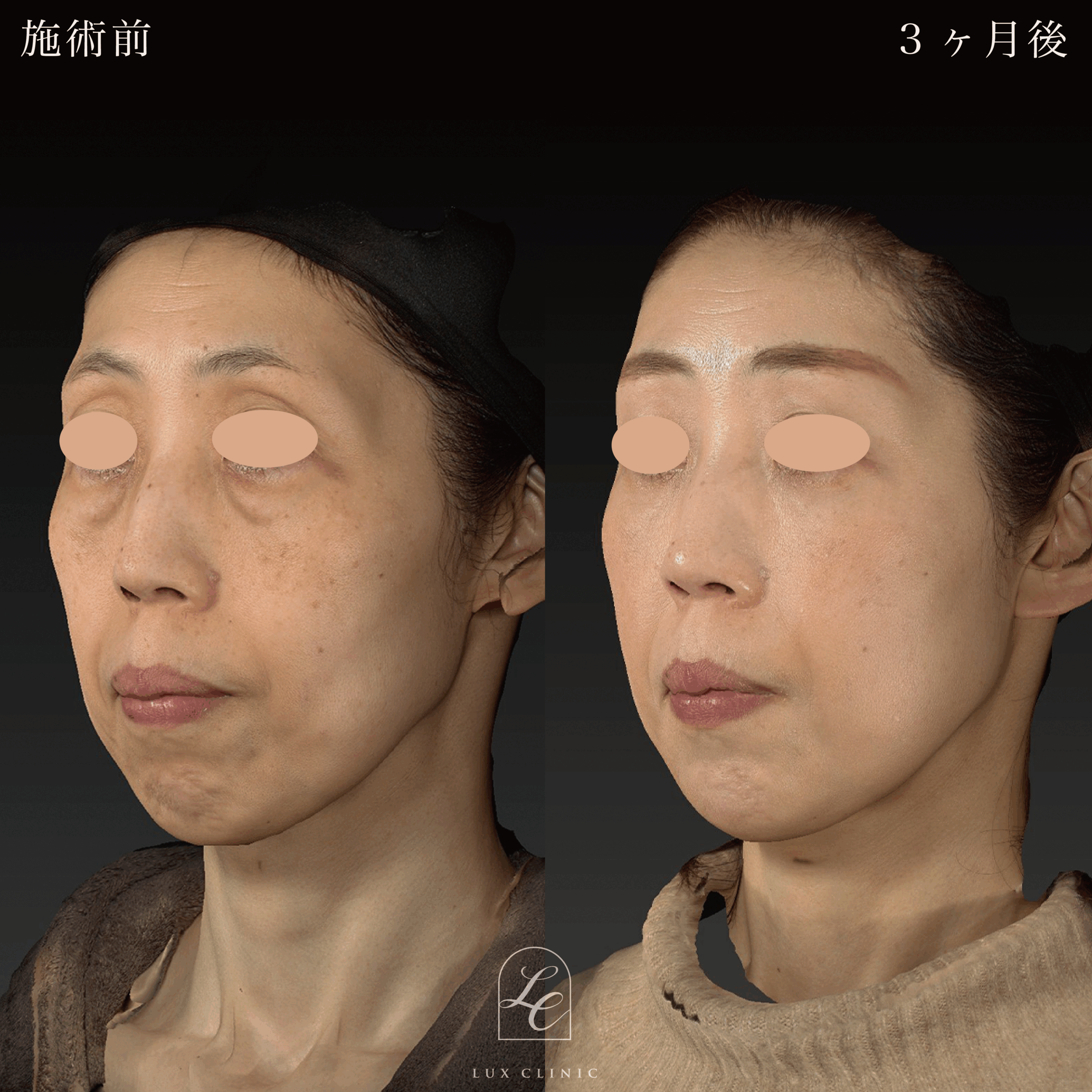 目の下のふくらみ取り（脱脂）術 ＋コンデンスリッチ脂肪注入 ＜顔全体・首＞