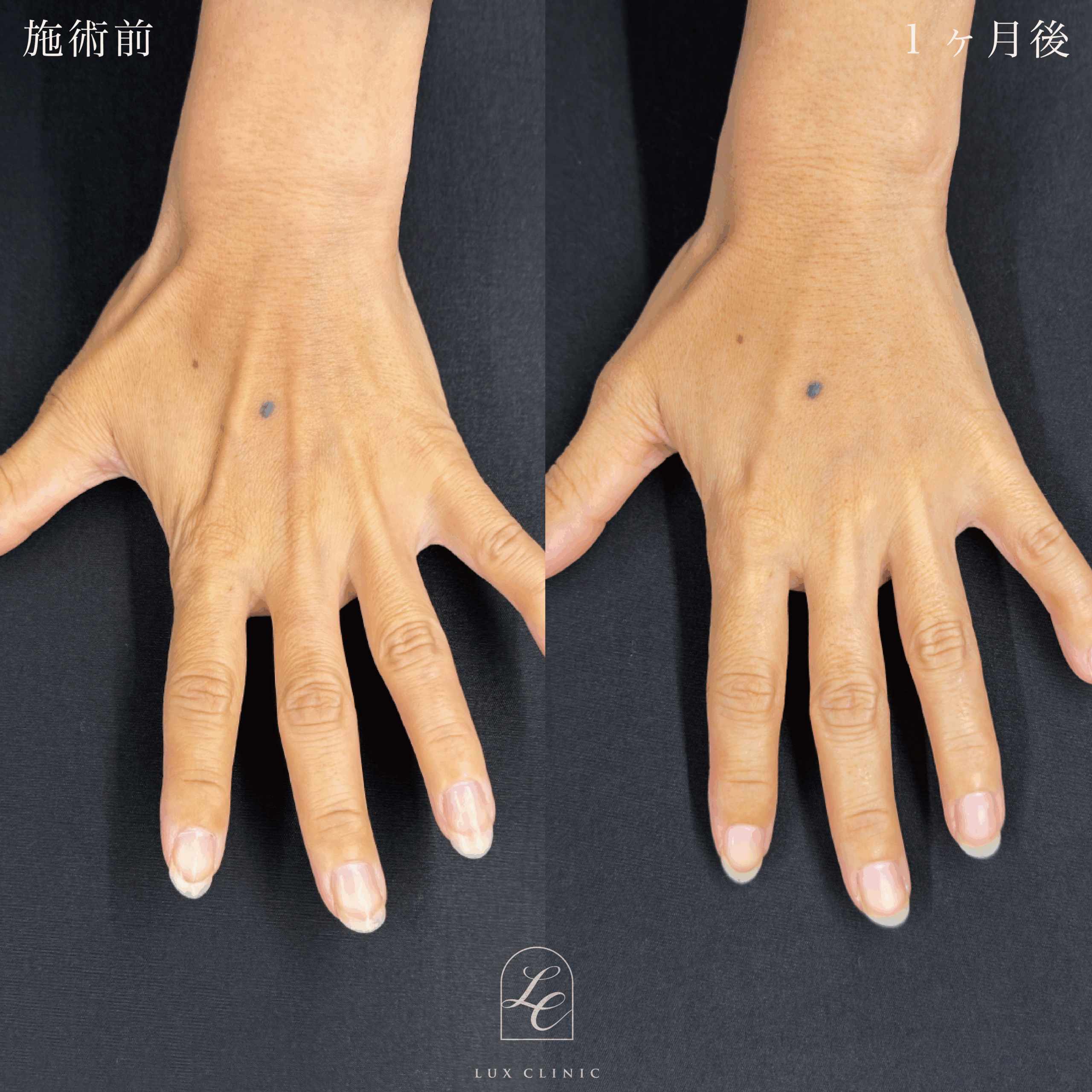 コンデンスリッチ脂肪注入 ＜手の甲＞