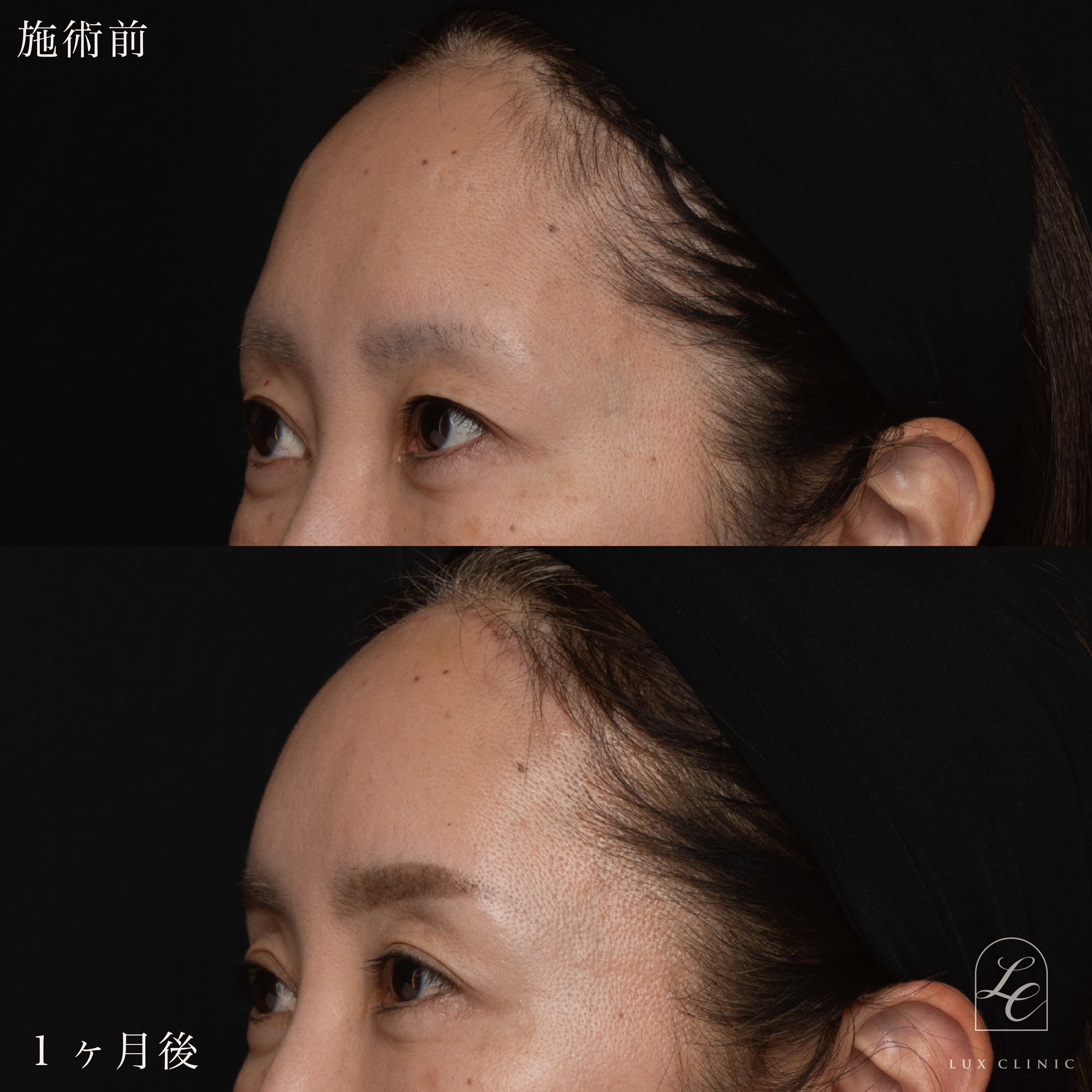 前額リフト＋コンデンスリッチ脂肪注入＜顔全体、首＞