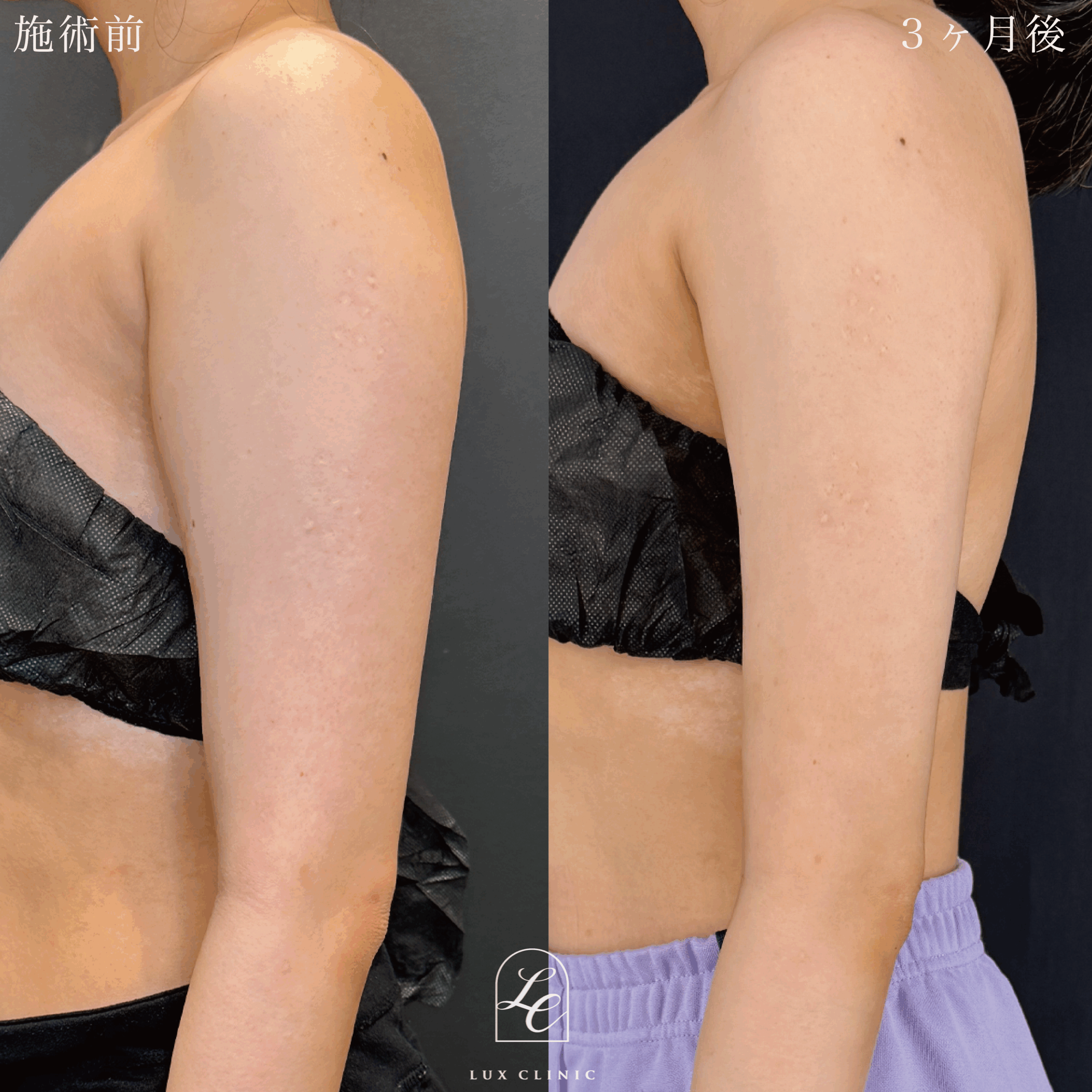 Ultra-Z 脂肪吸引 ＜二の腕（全周）・肩＞