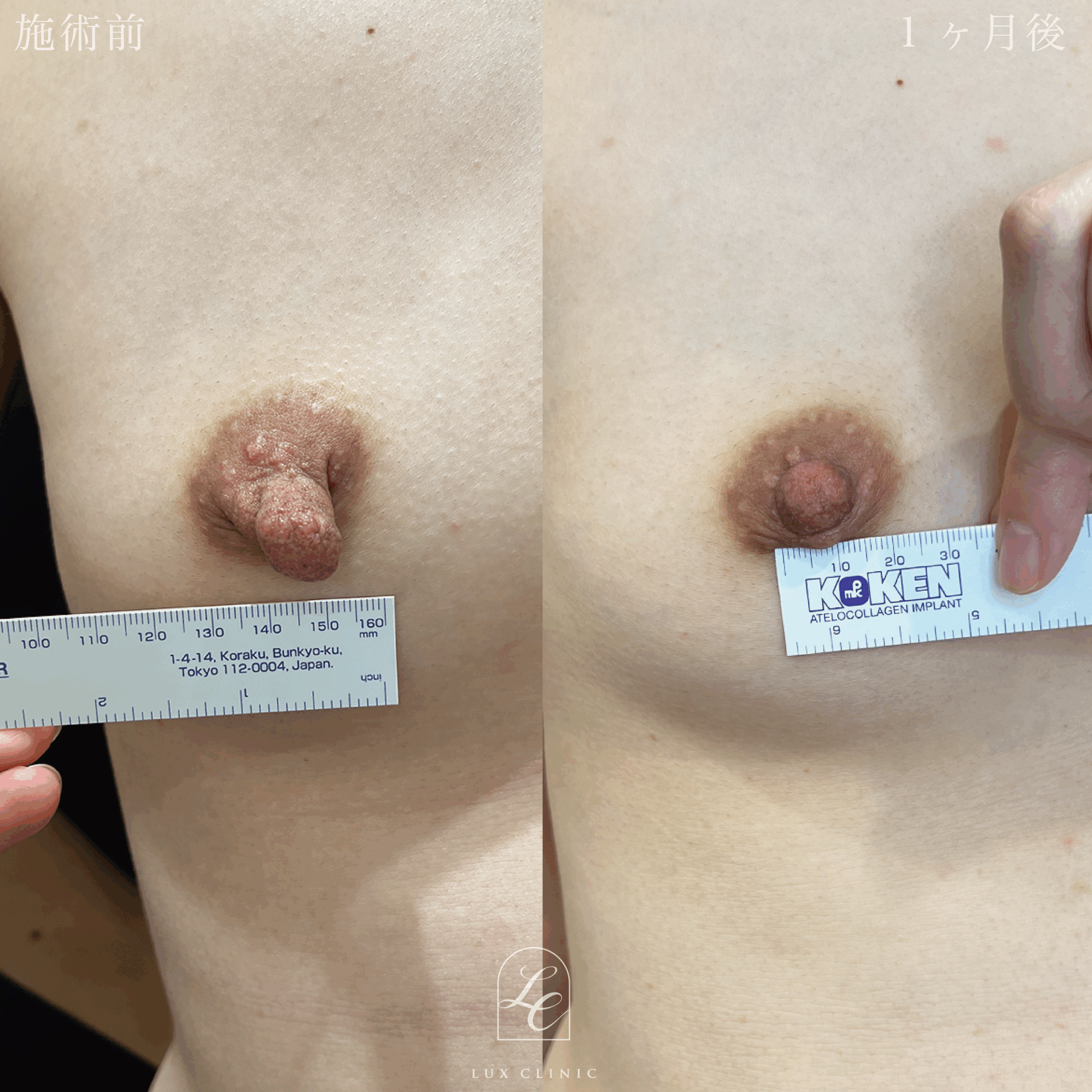 乳頭縮小術（乳管温存あり）＋ 乳輪縮小術（内側切開）