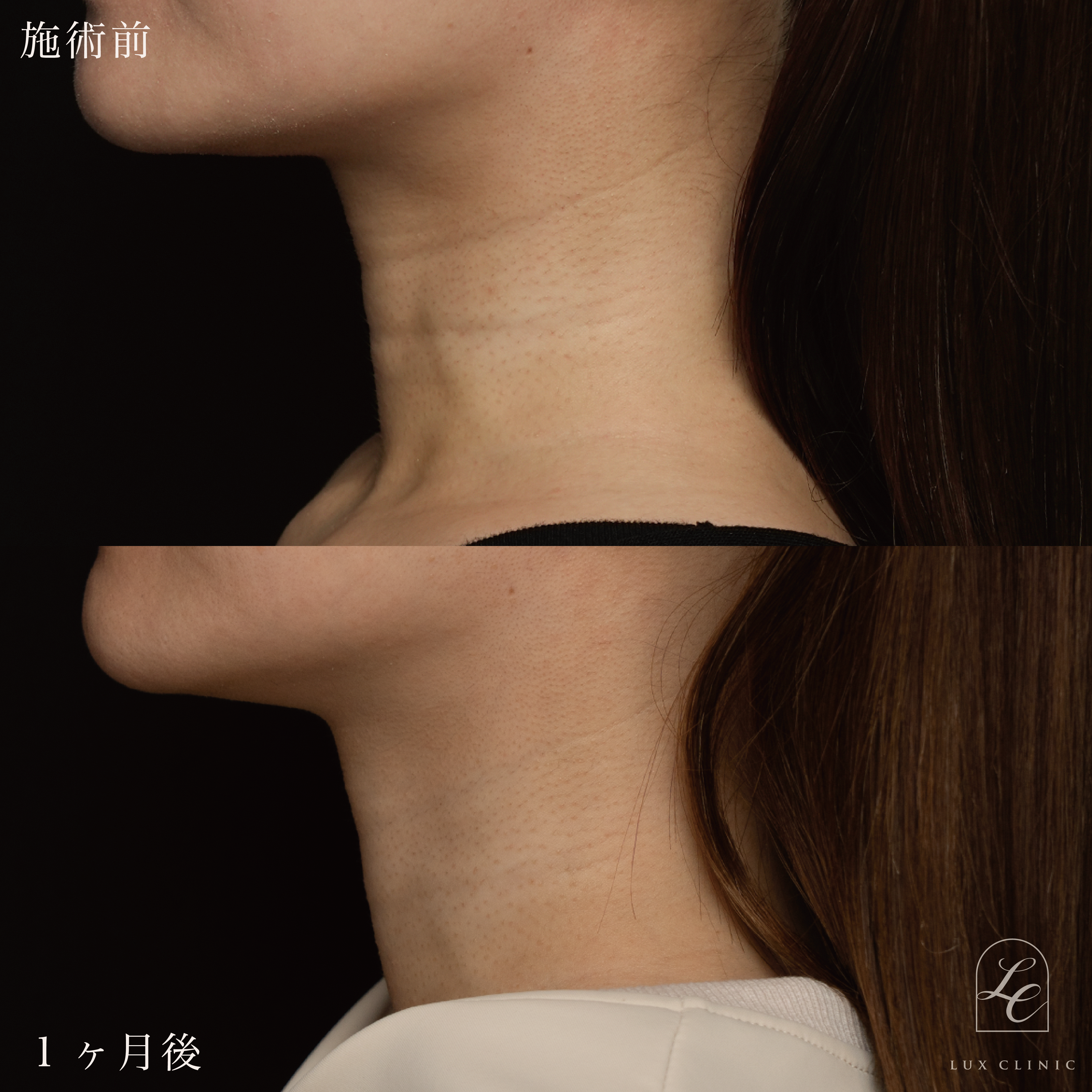 プルリアル バイオスカルプチャー2.2cc ＜首＞