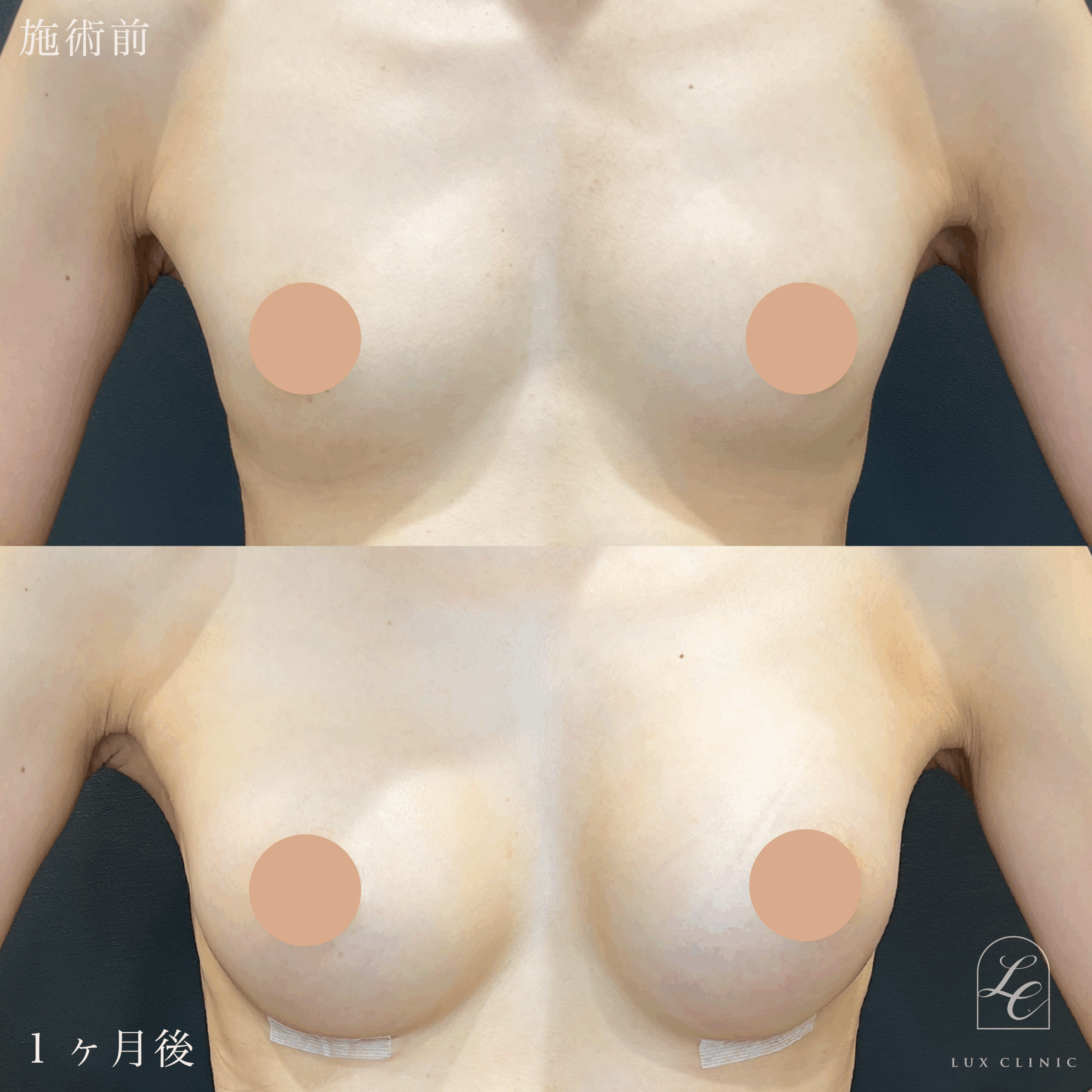 シリコンバッグ豊胸（乳房下切開）motiva ergonomix2 210cc demi