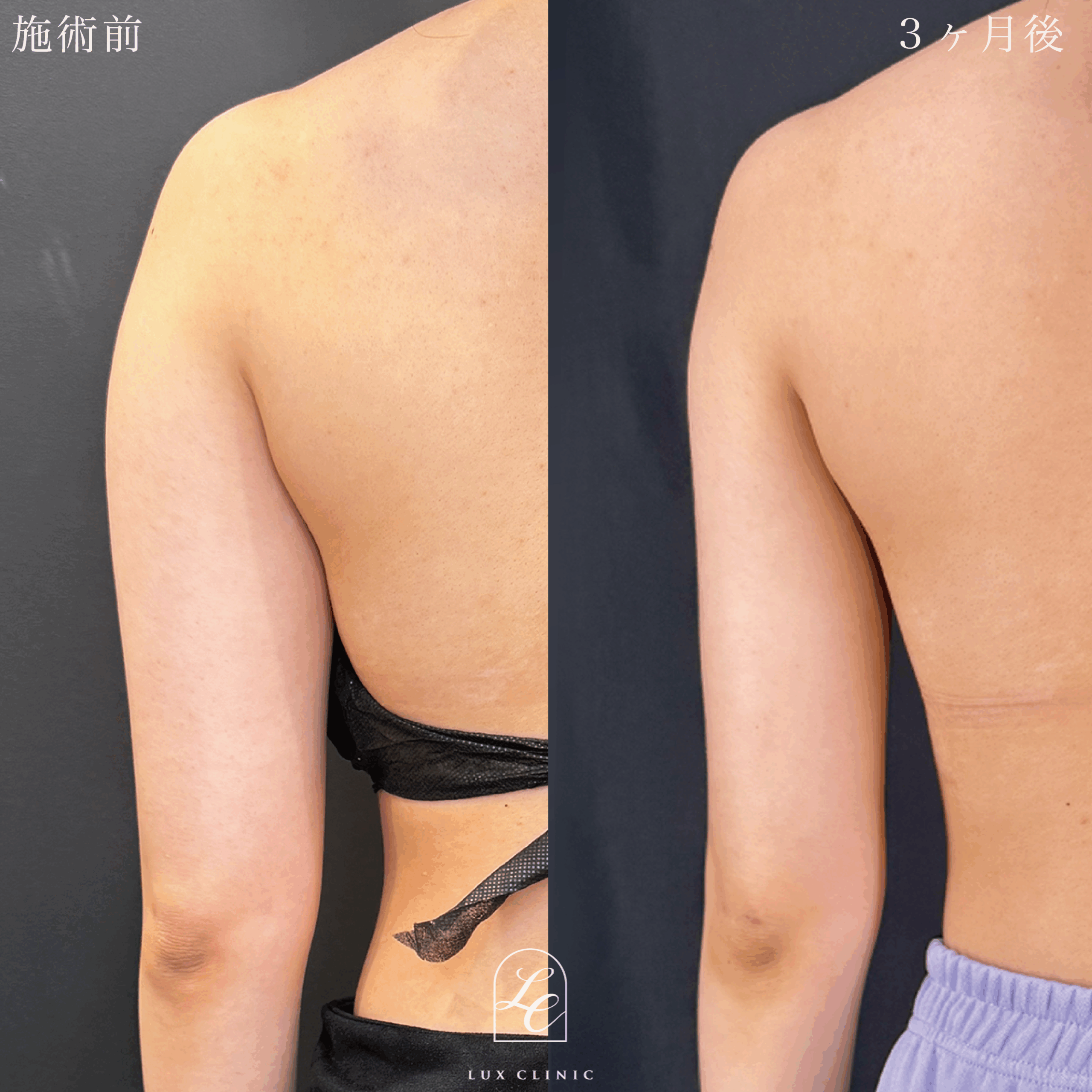 Ultra-Z 脂肪吸引 ＜二の腕（全周）・肩＞