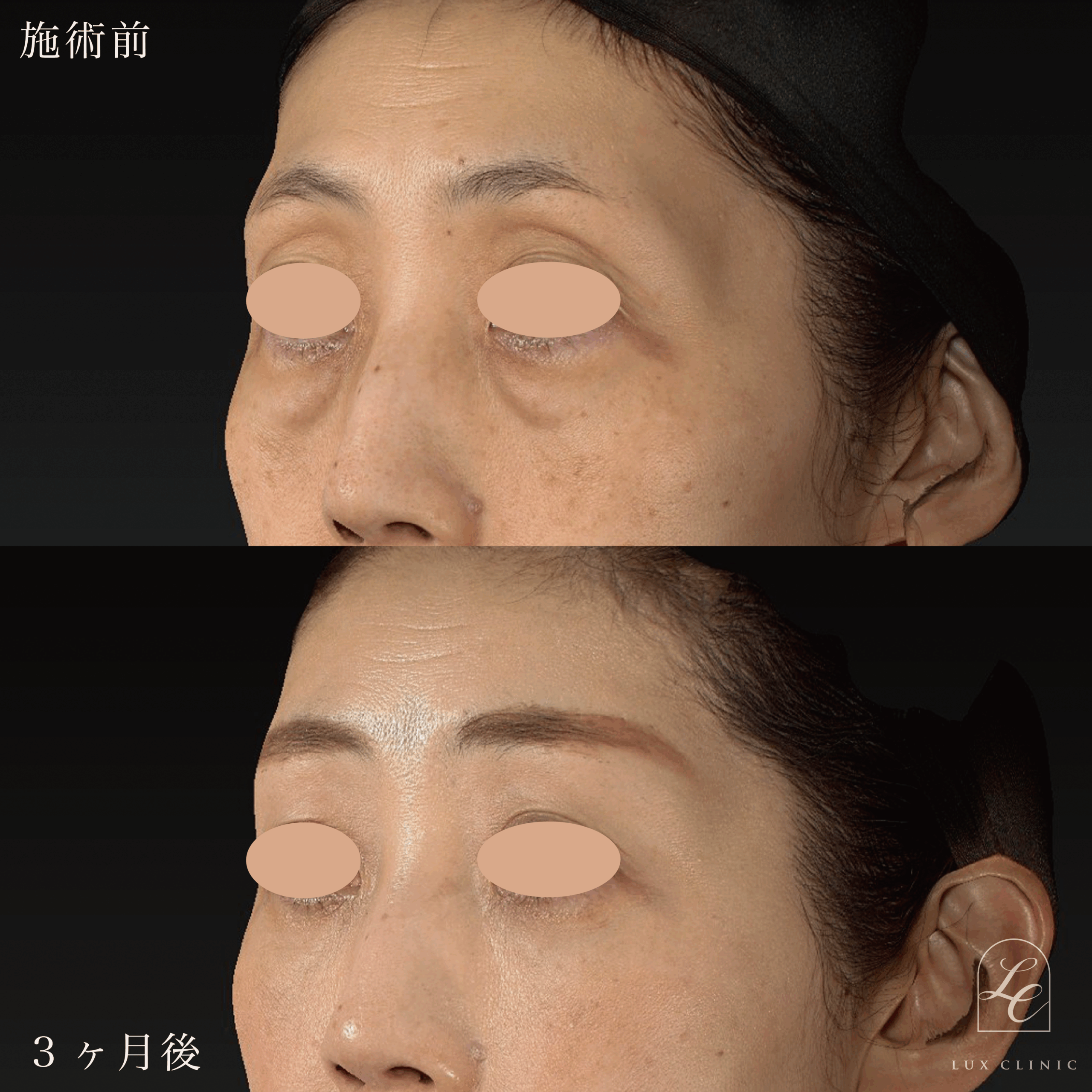 ミニフェイスリフト ＋ 糸リフト 10本 - ルクスクリニック｜東京・銀座
